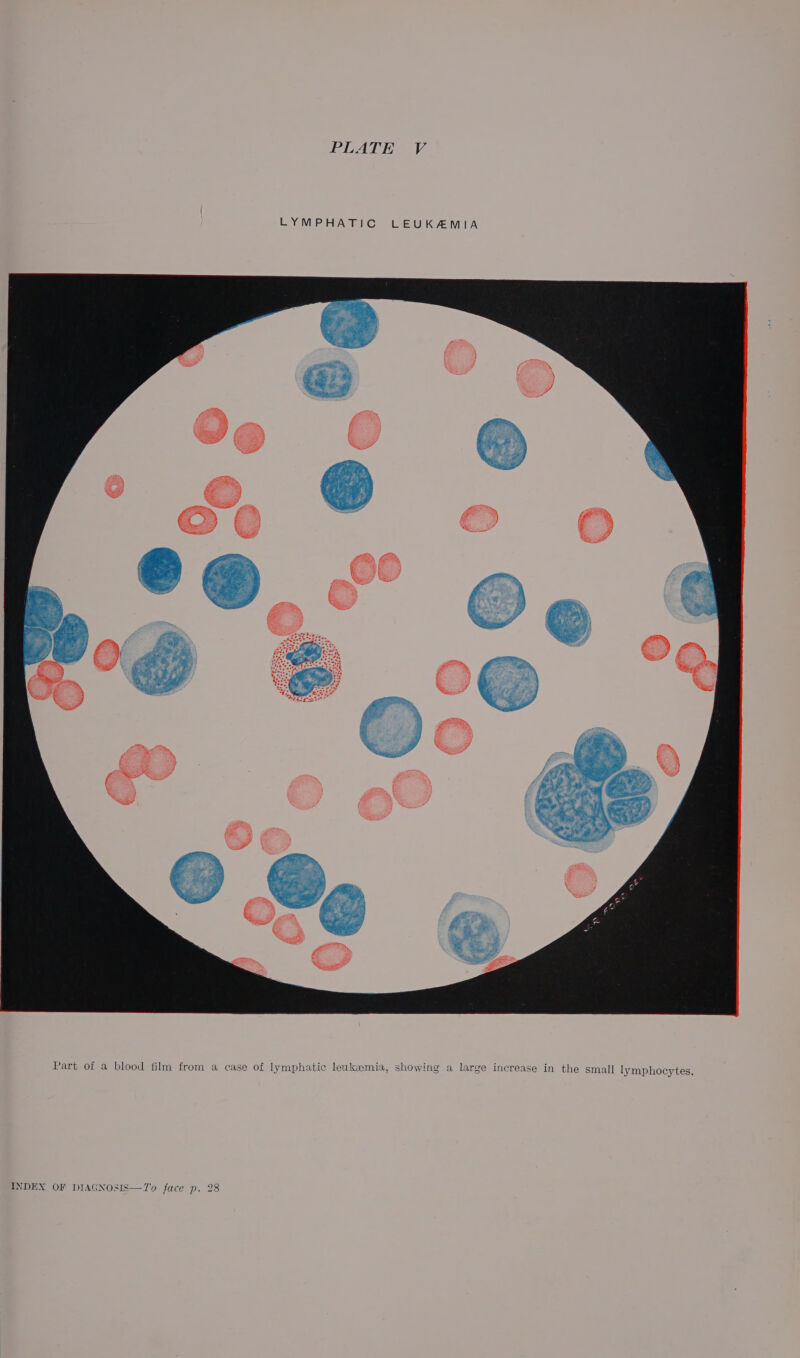 Part of a blood film from a case of lymphatic leukaemia, showing a large increase in the small lymphocytes.