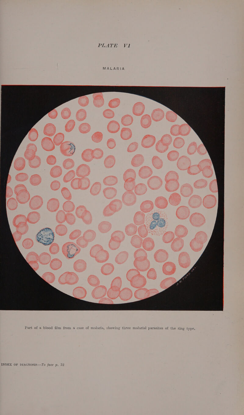 Part of a blood film from a case of malaria, showing three malarial parasites of the ring type.