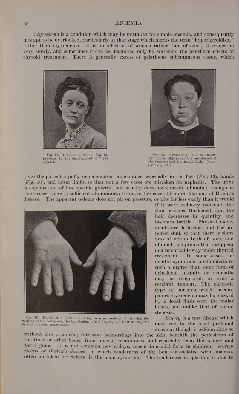 Myxedema is a condition which may be mistaken for simple anzemia, and consequently it is apt to be overlooked, particularly at that stage which merits the term ‘ hypothyroidism ’ rather than myxcedema. It is an affection of women rather than of men; it comes on very slowly, and sometimes it can be diagnosed only by watching the beneficial effects of thyroid treatment. There is generally excess of gelatinous subcutaneous tissue, which Fig. 14. The same patient as 27g. 15, Fig. 15.—Myxcedema: the character- previous to the development of myx- istic facies, illustrating the broadening of cedema. the features and the malar flush. (Com- pare Mig. 14.) gives the patient a puffy or oedematous appearance, especially in the face (fig. 15), hands (Fig. 16), and lower limbs, so that not a few cases are mistaken for nephritis. The urine is copious and of low specific gravity, but usually does not contain albumin ; though in some cases there is sufficient albuminuria to make the case still more like one of Bright’s disease.. The apparent cedema does not pit on pressure, or pits far less easily than it would if it were ordinary cedema; the skin becomes thickened, and the hair decreases in quantity and becomes brittle. Physical move- ments are lethargic, and the in- tellect dull, so that there is slow- ness of action both of body and of mind, symptoms that disappear in a remarkable way under thyroid treatment. In some cases the mental symptoms predominate to such a degree that some form of delusional insanity or dementia may be diagnosed, or even a cerebral tumour. The chlorotic type of anzemia which accom- panies myxcedema may be masked by a local flush over the malar bones, not unlike that of mitral : stenosis. : ane APA en Be age suffering from myxcedema, illustrating the Scurvy is a rare disease which welling Ol the soit parts, the broadening of the fingers, and their consequent stumpy or podgy appearance. ‘ ; Le ) lead to the most profound anzmia, though it seldom does so without also producing extensive hemorrhage into the skin, beneath the periosteum of the tibiz or other bones, from mucous membranes, and especially from the spongy and foetid gums. It is not common now-a-days, except in a mild form in children,—scurvy- rickets or Barlow's disease—in which tenderness of the bones associated with anemia, often mistaken for rickets is the main symptom. The tenderness in question is due to