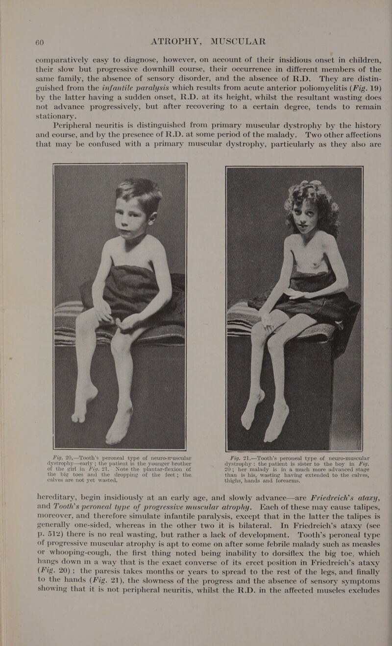 comparatively easy to diagnose, however, on account of their insidious onset in children, their slow but progressive downhill course, their occurrence in different members of the same family, the absence of sensory disorder, and the absence of R.D. They are distin- guished from the infantile paralysis which results from acute anterior poliomyelitis (Fig. 19) by the latter having a sudden onset, R.D. at its height, whilst the resultant wasting does not advance progressively, but after recovering to a certain degree, tends to remain stationary. Peripheral neuritis is distinguished from primary muscular dystrophy by the history and course, and by the presence of R.D. at some period of the malady. Two other affections that may be confused with a primary muscular dystrophy, particularly as they also are Fig. 21.—Tooth’s peroneal type of neuro-muscular of the girl in Fig. 21. Note the plantar-flexion’ of the big toes and the dropping of the feet; the calves are not yet wasted. 20; her malady is in a much more advanced stage than is his, wasting having extended to the calves, thighs, hands and forearms. hereditary, begin insidiously at an early age, and slowly advance—are Friedreich’s ataxy, and Tooth’s peroneal type of progressive muscular atrophy. Each of these may cause talipes, moreover, and therefore simulate infantile paralysis, except that in the latter the talipes is generally one-sided, whereas in the other two it is bilateral. In Friedreich’s ataxy (see p. 512) there is no real wasting, but rather a lack of development. Tooth’s peroneal type of progressive muscular atrophy is apt to come on after some febrile malady such as measles or whooping-cough, the first thing noted being inability to dorsiflex the big toe, which hangs down in a way that is the exact converse of its erect position in Friedreich’s ataxy (Fig. 20); the paresis takes months or years to spread to the rest of the legs, and finally to the hands (Fig. 21), the slowness of the progress and the absence of sensory symptoms showing that it is not peripheral neuritis, whilst the R.D. in the affected muscles excludes