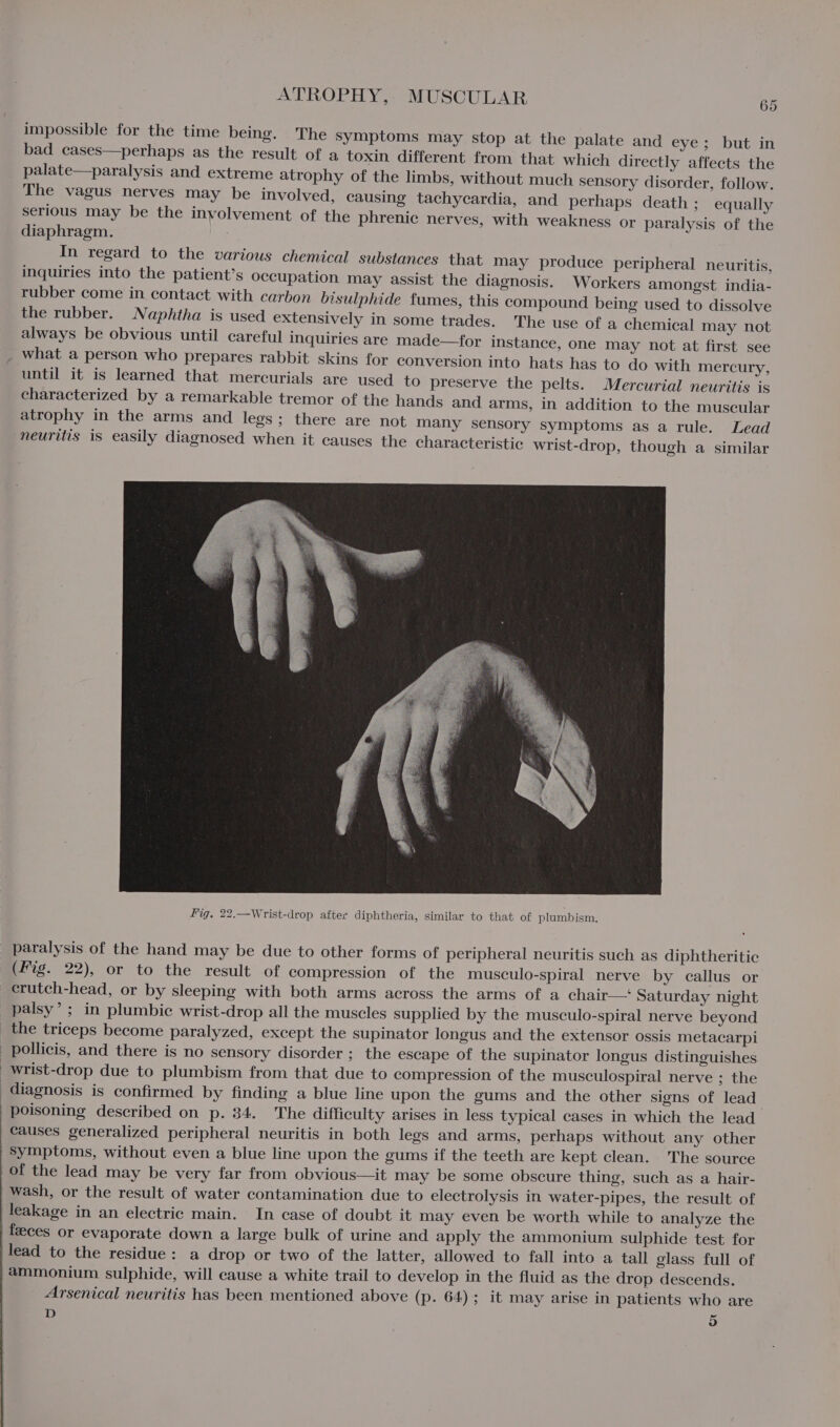 impossible for the time being. The Symptoms may stop at the palate and eye; but in bad cases—perhaps as the result of a toxin different from that which directly affects the palate—paralysis and extreme atrophy of the limbs, without much sensory disorder, follow. The vagus nerves may be involved, causing tachycardia, and perhaps death ; equally serious may be the involvement of the phrenic nerves, with weakness or paralysis of the diaphragm. In regard to the various chemical substances that may produce peripheral neuritis, inquiries into the patient’s occupation may assist the diagnosis. Workers amongst india- rubber come in contact with carbon bisulphide fumes, this compound being used to dissolve the rubber. Naphtha is used extensively in some trades. The use of a chemical may not always be obvious until careful inquiries are made—for instance, one may not at first see what a person who prepares rabbit skins for conversion into hats has to do with mercury, until it is learned that mercurials are used to preserve the pelts. Mercurial neuritis is characterized by a remarkable tremor of the hands and arms, in addition to the muscular atrophy in the arms and legs; there are not many sensory symptoms as a rule. Lead neuritis is easily diagnosed when it causes the characteristic wrist-drop, though a similar paralysis of the hand may be due to other forms of peripheral neuritis such as diphtheritic (Fig. 22), or to the result of compression of the musculo-spiral nerve by callus or crutch-head, or by sleeping with both arms across the arms of a chair— Saturday night palsy’; in plumbie wrist-drop all the muscles supplied by the musculo-spiral nerve beyond the triceps become paralyzed, except the supinator longus and the extensor ossis metacarpi pollicis, and there is no sensory disorder ; the escape of the supinator longus distinguishes : wrist-drop due to plumbism from that due to compression of the musculospiral nerve ; the diagnosis is confirmed by finding a blue line upon the gums and the other signs of lead poisoning described on p. 34. The difficulty arises in less typical cases in which the lead Causes generalized peripheral neuritis in both legs and arms, perhaps without any other symptoms, without even a blue line upon the gums if the teeth are kept clean. The source of the lead may be very far from obvious—it may be some obscure thing, such as a hair- wash, or the result of water contamination due to electrolysis in water-pipes, the result of leakage in an electric main. In case of doubt it may even be worth while to analyze the feeces or evaporate down a large bulk of urine and apply the ammonium sulphide test for lead to the residue: a drop or two of the latter, allowed to fall into a tall glass full of ammonium sulphide, will cause a white trail to develop in the fluid as the drop descends. Arsenical neuritis has been mentioned above (p. 64); it may arise in patients who are D 3