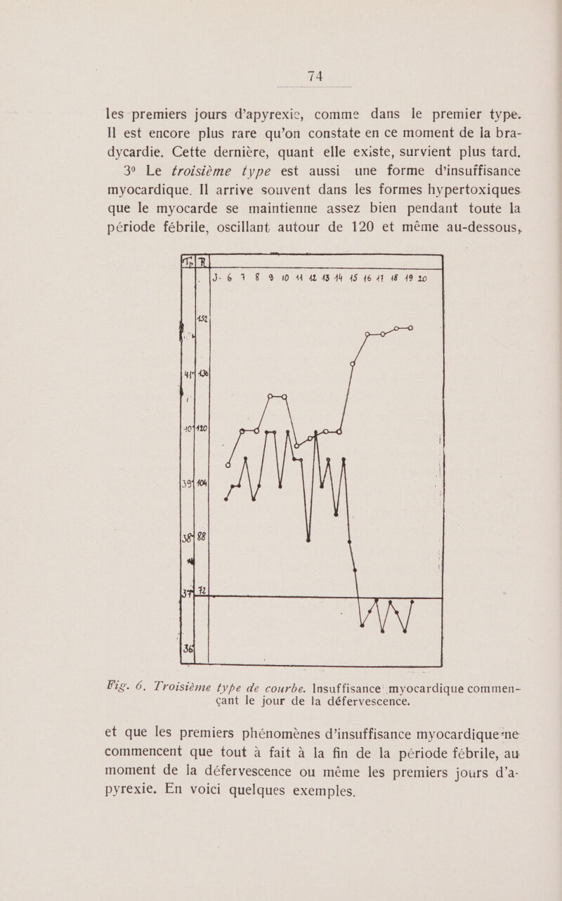 les premiers jours d’apyrexie, comme dans le premier type. Il est encore plus rare qu’on constate en ce moment de Îa bra- dycardie. Cette dernière, quant elle existe, survient plus tard. 3 Le éroisième type est aussi une forme d’insuifisance myocardique. Il arrive souvent dans les formes hypertoxiques que le myocarde se maintienne assez bien pendant toute la période fébrile, oscillant autour de 120 et même au-dessous, Fig. 6. Troisième type de courbe. Insuffisance: myocardique commen- çant le jour de la défervescence. et que les premiers phénomènes d’insuffisance myocardique-ne commencent que tout à fait à la fin de la période fébrile, au moment de la défervescence ou même les premiers jours d’a- pyrexie. En voici quelques exemples.