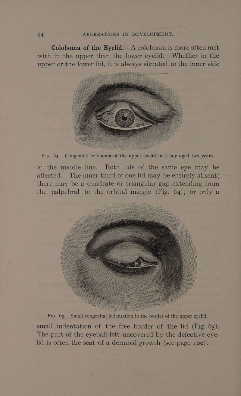 Coloboma of the Eyelid.—A coloboma is more often met with in the upper than the lower eyelid. Whether in the upper or the lower lid, it is always situated to the inner side Fic. 64.—Congenital coloboma of the upper eyelid in a boy aged two years. of the middle line. Both lids of the same eye may be affected. The inner third of one lid may be entirely absent; there may be a quadrate or triangular gap extending from the palpebral to the orbital margin (Fig. 64); or only a Fic. 65.—Small congenital indentation in the border of the upper eyelid. small indentation of the free border of the lid (Fig. 65). The part of the eyeball left uncovered by the defective eye- lid is often the seat of a dermoid growth (see page 100).
