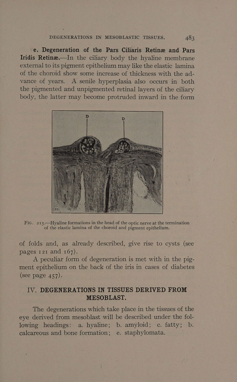 e. Degeneration of the Pars Ciliaris Retine and Pars Iridis Retine.—In the ciliary body the hyaline membrane external to its pigment epithelium may like the elastic lamina of the choroid show some increase of thickness with the ad- vance of years. A senile hyperplasia also occurs in both the pigmented and unpigmented retinal layers of the ciliary body, the latter may become protruded inward in the form Fic. 215.—Hyaline formations in the head of the optic nerve at the termination of the elastic lamina of the choroid and pigment epithelium. of folds and, as already described, give rise to cysts (see pages 121 and 167). | A peculiar form of degeneration is met with in the pig- ment epithelium on the back of the iris in cases of diabetes (see page 457). IV. DEGENERATIONS IN TISSUES DERIVED FROM MESOBLAST. The degenerations which take place in the tissues of the eye derived from mesoblast will be described under the fol- lowing headings: a. hyaline; b. amyloid; c. fatty; b. calcareous and bone formation; e. staphylomata.