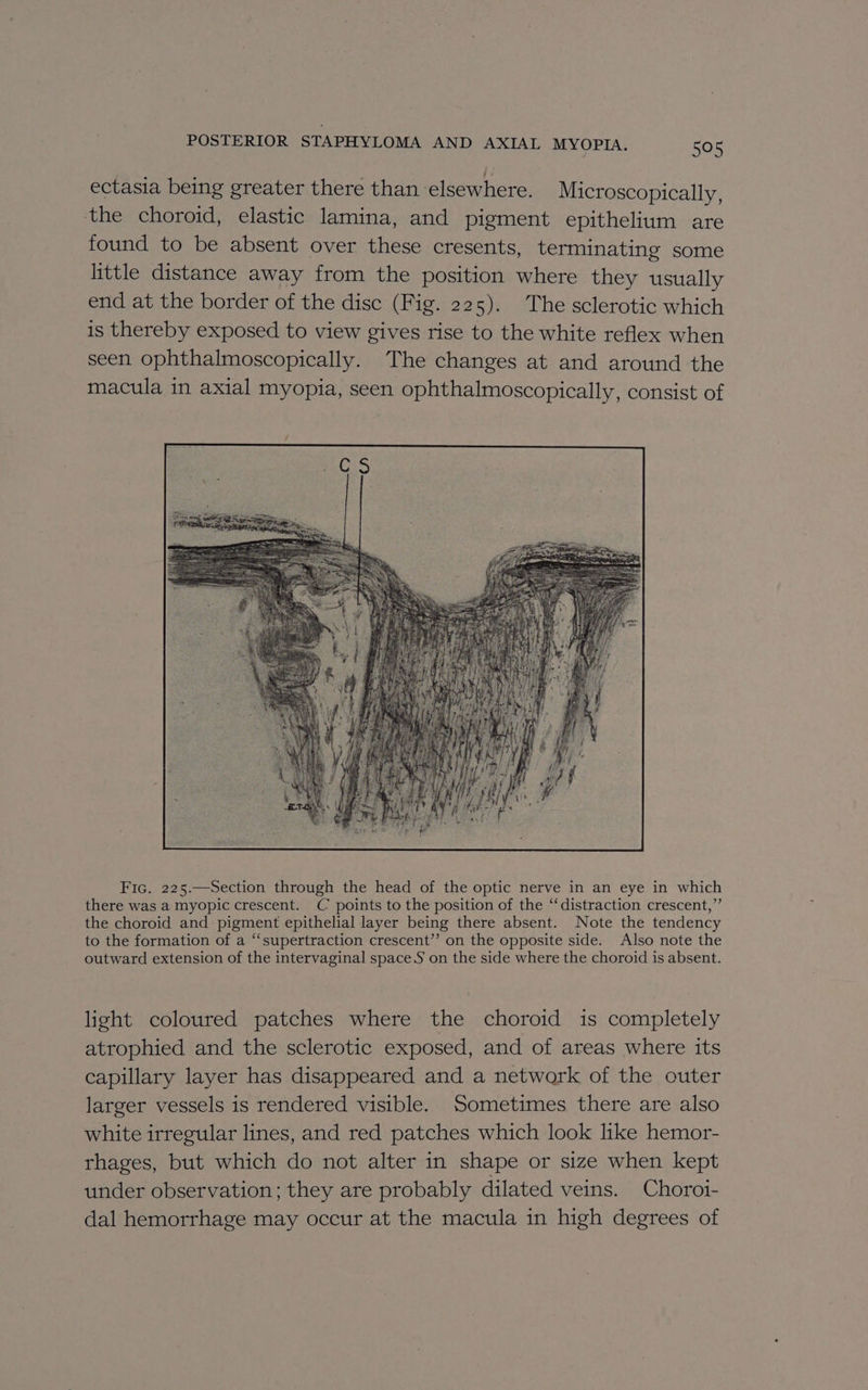 ectasia being greater there than elsewhere. Microscopically, the choroid, elastic lamina, and pigment epithelium are found to be absent over these cresents, terminating some little distance away from the position where they usually end at the border of the disc (Fig. 225). The sclerotic which is thereby exposed to view gives rise to the white reflex when seen ophthalmoscopically. The changes at and around the macula in axial myopia, seen ophthalmoscopically, consist of Fic. 225.—Section through the head of the optic nerve in an eye in which there was a myopic crescent. C points to the position of the “‘distraction crescent,” the choroid and pigment epithelial layer being there absent. Note the tendency to the formation of a “‘supertraction crescent’’ on the opposite side. Also note the outward extension of the intervaginal space.S on the side where the choroid is absent. light coloured patches where the choroid is completely atrophied and the sclerotic exposed, and of areas where its capillary layer has disappeared and a network of the outer larger vessels is rendered visible. Sometimes there are also white irregular lines, and red patches which look like hemor- rhages, but which do not alter in shape or size when kept under observation; they are probably dilated veins. Choroi- dal hemorrhage may occur at the macula in high degrees of