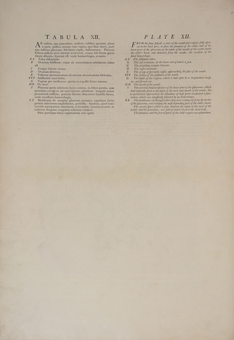 Uae BeUY LA UXH. yas eadem, qua precedens, muliere, exhibet apertum plane a parte poftica uterum cum vagina, quo fitus foetus, parf- que inferior placenta, fub foetus capite, indicarentur. Placenta {cilicet orificio uteri interno accreverat, eoque fub finem gravi- ditatis dilatato, feparata eft: unde hemorrhagia, et mors. : AA Tubz fallopiane. B Ovarium finiftrum; cujus ad extremitatem inferiorem videre cht pO USE C Corpus luteum extans. D Ovarium dextrum. E Vaforum fpermaticorum ad uterum afcendentium fafciculus. FFF Subftantiz uteri fectio. E d G Vaginz per incifionem aperte et expaffz facies interna. HH Os uteri. 1 Placentz partis inferioris facies externa, in lobos partita, quae quondam cervici et ori uteri interne adhaferat; tempore autem parturiendi inftante, partium illarum dilatatione fejuncta fuerat, unde neceffario hemorrhagia. KK Membrane de margine placenta. exeuntes, capitifque foctus partem inferiorem amplectentes, perfciffie.. Spatium, quod inter cervicis uteri partem interiorem, et fecundas, vacuum occurrit, in cadavere fanguine coagulato refertum comperi. Situs partefque foetus explanatione non egent. . PUE AGT eee ar Jas OM the fame fubjed, a view of the womb and vagina fully open- ed on the back part, to shew the fituation of the child, and of the lower part of the placenta at the infide of the mouth of the womb, under the child's head, and detached from the womb; the occafion of the fatal hemorrhage. AA The fallopian tubes. B. Te left ovarium, at the lower end of which is feen C The projecting corpus luteum. D The right ovarium. E The group of [permatic veffels approaching the fides of the womb. FFF The fection of the Jubflance of the womb. boire - G The infide of the vagina, which is laid open by a longitudinal incifi- on, and [pread out. HH The mouth of the womb. I The external lobulated furface of the lower part of the placenta ; which had originally ftuck to the infide of the neck and mouth of the womb ; but as parturition approached, the dilatation of thefe parts occafoned a fepa- ration, which was neceffarily followed by an hemorrhage. KK | Themembranes cut through where they were coming out from the border of the placenta, and enclofing the moft depending part of the child's head. The vacant [pace which is feen between the infide of the neck of the womb, and the fecundines, was full of clotted blood in the dead body. The fituation, and the feveral parts of the child require no explanation.