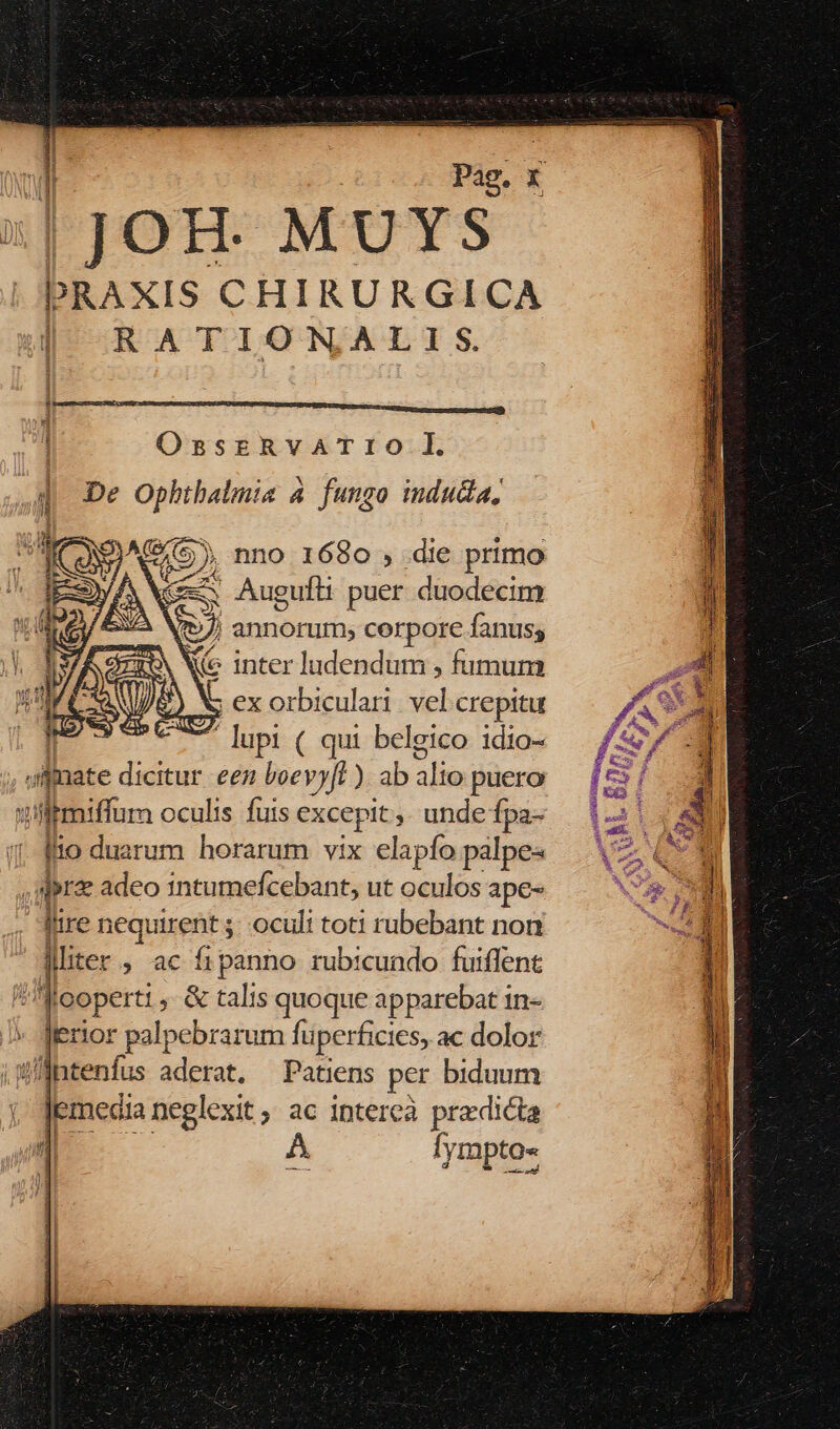 Pag. x | JOH. MUYS PRAXIS CHIRURGICA | RAT IONALI S. OssrRvATIO lI 4d De Ophtbalmia 4 fungo indudia, /5), nno 1680 ; die primo Gm Augufli puer duodecim 5. annorum; corpore fanuss M inter ludendum , fumum , ex orbiculari. vel crepitu - lupi ( qui beleico idio- i dfnate dicitur een boev »f )ab die puero illtmiffum oculis fuis excepit ; unde fpa- ito duarum horarum vix elapío palpe« ' qr adeo intumefcebant, ut oculos ape- lire nequirent 5; oculi toti rubebant non que; ac fipanno rubicuado fuiffent Wooperti ; &amp; talis quoque apparebat 1n- jerior palpebrarum fuperficies, ac dolor 'Inte enfus ur. Patiens per biduum j Jemecia neglexit ; ac intereà predicta Jimi A Iympto- f ——