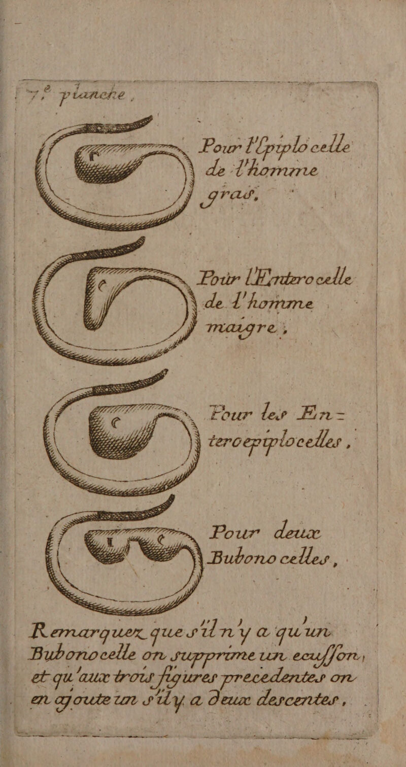 pores Pour Fpiplo celle | Re rl | fe er AN = Par rrocelle 3 de. l'homme d Pere) 7 À Four les En- À tercepiploceles ; | tqs uer que sl y à qu'un Bubono on eur OT et qu'aux trou ; “AL ART 8 | ri laut af agité A jé mere si ane Eh mire aline EE