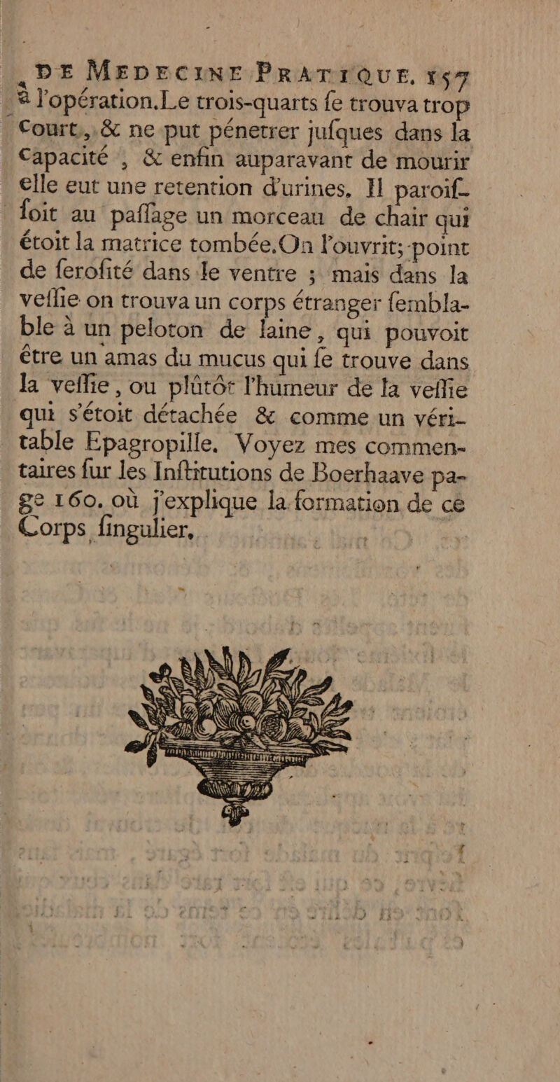 .* l'opération. Le trois-quarts fe trouva trop Court, &amp; ne put pénetrer jufques dans la Capacité , &amp; enfin auparavant de mourir elle eut une retention d'urines, H paroif- foit au pañlage un morcean de chair qui étoit la matrice tombée.On louvrit; point de ferofité dans le ventre ; mais dans la veflie on trouva un corps étranger fermbla- ble à un peloton de laine, qui pouvoit être un amas du mucus qui fe trouve dans la veñlie, ou plûtôt l'humeur de la veflie qui s’étoit détachée &amp; comme un véri- table Epagropille, Voyez mes commen- taires fur les Inftitutions de Boerhaave pa- ge 160. où j'explique la. formation de ce Corps fingulier,