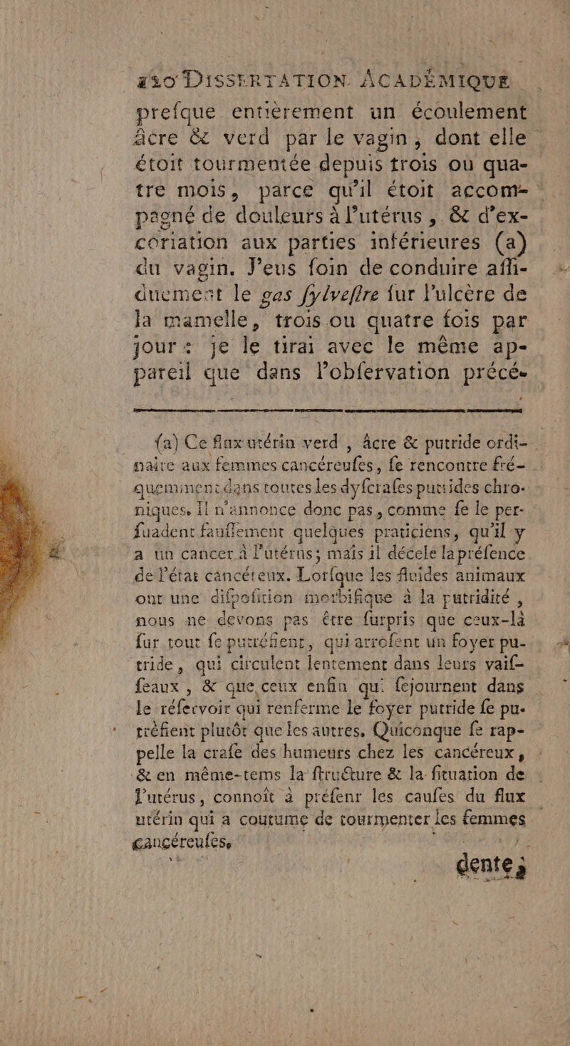 prefque entièrement un écoulement âcre &amp;c verd par le vagin; dont elle étoit tourmentée depuis trois où qua- tre mois parce qu'il étoit accom- pagné de douleurs à utérus , &amp; d’ex- coriation aux parties inférieures (a) du vagin. J’eus foin de conduire afli- duement le gas Jydveftre ur l'ulcère de la mamelle trois ou quatre fois par jour+ je Île tirai avec le même ap- pareil que dans lobfervation précé. PSE Ch QET (a) Ce flux utérin verd , âcre &amp; putride ordi- nare aux femmes cancéreufes, fe rencontre fré- quemment dans touresles dyfcrafes putrides chro- niques, Îl n’annonce donc pas, comme fe le per- fuadent faufement quelques praticiens, qu'il y a un cancer à l'utérus; mañs il décele la préfence de létar cancéteux. Lorfque les vides animaux ont une difpofition merbifique à la putridité , nous né devons: pas être furpris que ceux-là fur tout fe putréhent, quiarrofent un foyer pu- tride , qui circulent lentement dans leurs vaif- feaux , &amp; que ceux enfin qu fejournent dans le réfervoir qui renferme le foyer putride fe pu. tréfient plutôt que les autres, Quiconque fe rap- pelle la crafe des humeurs chez les cancéreux, &amp; en même-tems la ftructure &amp; la fituation de l'utérus, connoît à préfenr les caufes du flux urérin qui à coutume de tourmenter les Fans cancéreufes, denteà à