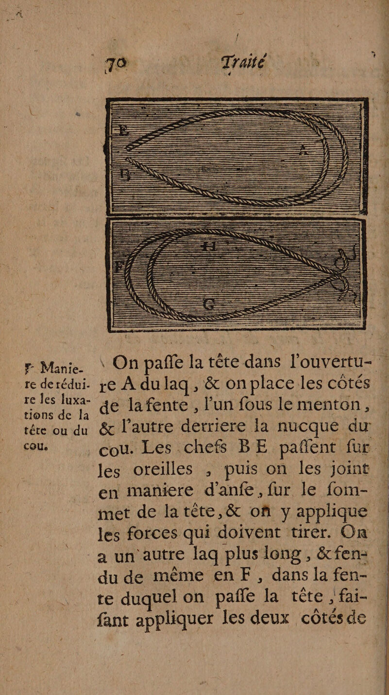 es = EEZEZEZLSK #7 | li] cl Ki ii I = Fr Mani. \ On pañle la tête dans l'ouvertu- … re derédui. re À dulaq, &amp; onplace les côtés Ru ne de lafente, l’un fous le menton, tére ou du &amp; l'autre derriere la nucque du cou. cou. Les chefs BE pañent fur les oreilles , puis on les joint : en maniere d'au. fur le fom- | met de latête,&amp; of y applique les forces qui doivent tirer. On a un autre laq plus long, &amp;fen- du de même en FE, dans la fen- te duquel on pañle la tête , fai- : fant appliquer les deux côtés de |