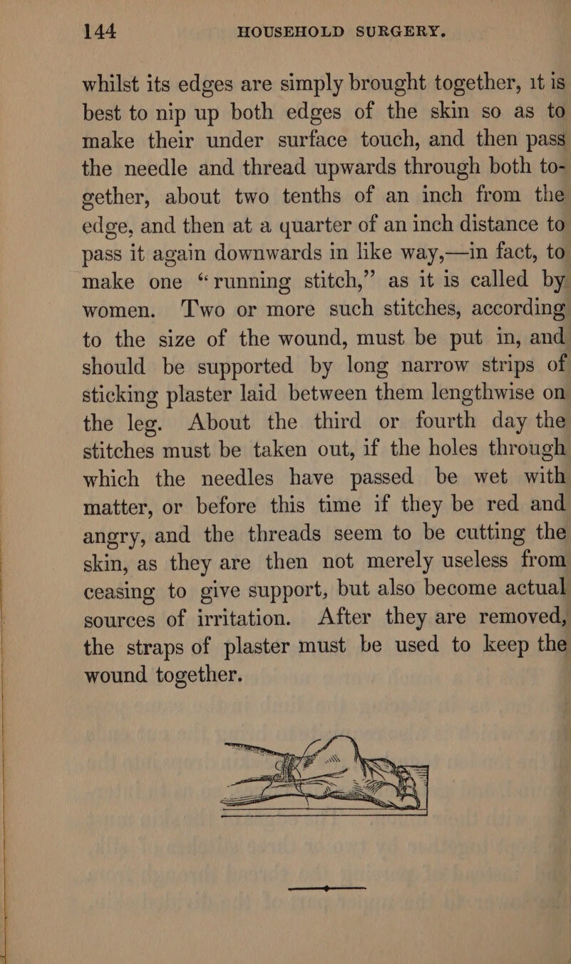 whilst its edges are simply brought together, 1t is best to nip up both edges of the skin so as to make their under surface touch, and then pass the needle and thread upwards through both to- gether, about two tenths of an inch from the edge, and then at a quarter of an inch distance to pass it again downwards in like way,—in fact, to make one “running stitch,” as it is called by women. ‘Two or more such stitches, according to the size of the wound, must be put in, and should be supported by long narrow strips of sticking plaster laid between them lengthwise on the leg. About the third or fourth day the stitches must be taken out, if the holes through which the needles have passed be wet with matter, or before this time if they be red and angry, and the threads seem to be cutting the skin, as they are then not merely useless from ceasing to give support, but also become actual sources of irritation. After they are removed, the straps of plaster must be used to keep the wound together.