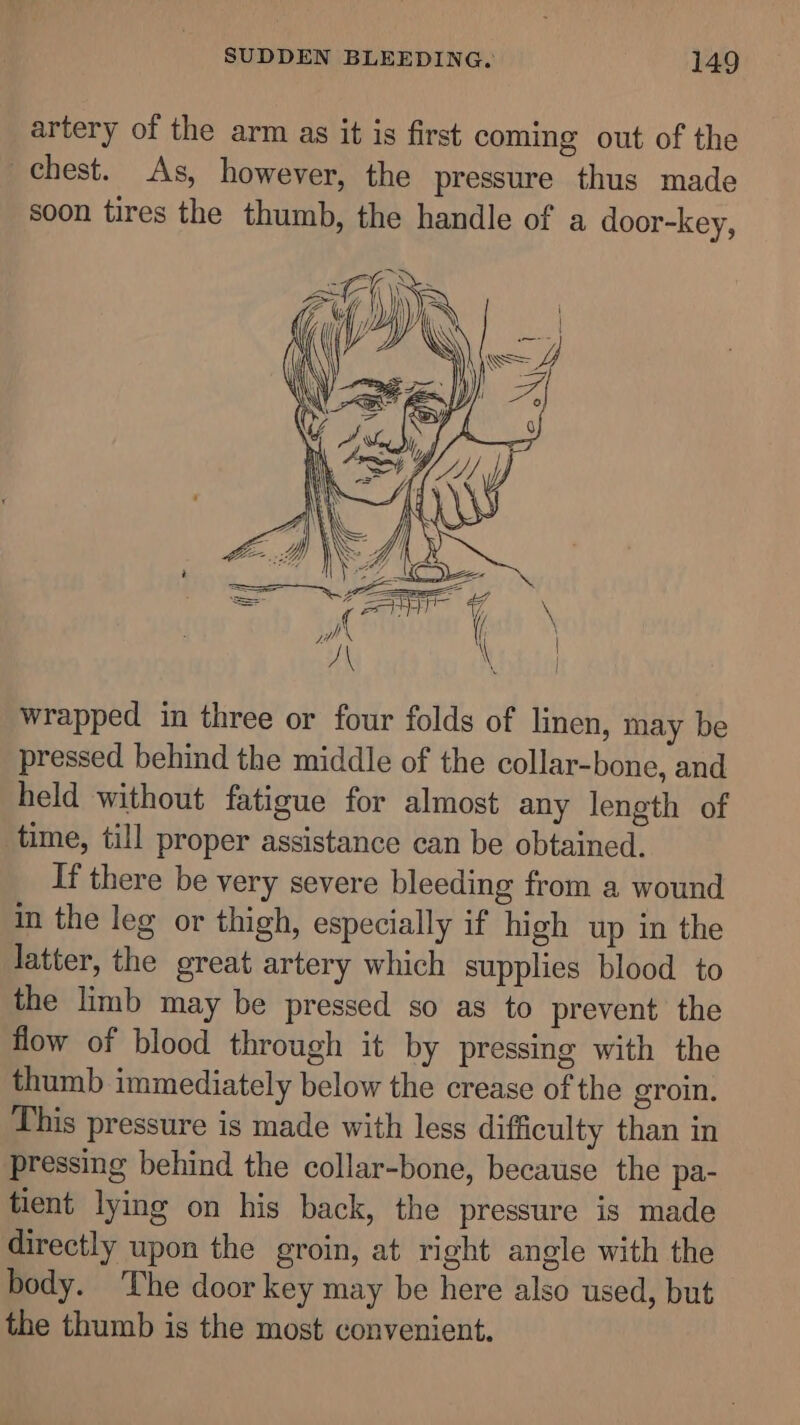 artery of the arm as it is first coming out of the chest. As, however, the pressure thus made soon tires the thumb, the handle of a door-key, wrapped in three or four folds of linen, may be pressed behind the middle of the collar-bone, and held without fatigue for almost any length of time, till proper assistance can be obtained. If there be very severe bleeding from a wound in the leg or thigh, especially if high up in the latter, the great artery which supplies blood to the limb may be pressed so as to prevent the flow of blood through it by pressing with the thumb immediately below the crease of the groin. This pressure is made with less difficulty than in pressing behind the collar-bone, because the pa- tient lying on his back, the pressure is made directly upon the groin, at right angle with the body. ‘The door key may be here also used, but the thumb is the most convenient.