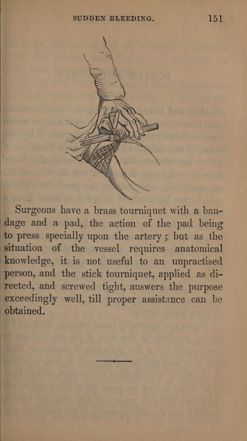 Surgeons have a brass tourniquet with a ban- dage and a pad, the action of the pad being to press specially upon the artery ; but as the situation of the vessel requires anatomical knowledge, it is not useful to an unpractised person, and the stick tourniquet, applied as di- rected, and screwed tight, answers the purpose exceedingly well, till proper assistance can be obtained.