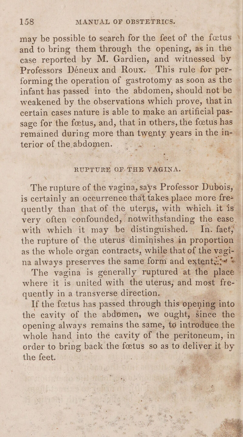 may be possible to search for the feet of the fetus » and to bring them through the opening, as in the case reported by M. Gardien, and witnessed by Professors Déneux and Roux. This rule for per- forming the operation of eastrotomy as soon as the infant has passed into the abdomen, should not be © weakened by the observations which prove, that in certain cases nature is able to make an artificial pas- sage for the foetus, and, that in others, the foetus has remained during more than twenty years in thes in- terior of ae a ae oe Pee Rr RUPTURE OF. THE VAGINA. ‘The rupture of the vagina, says Professor Diubbis, is certainly an occurrence that takes place more fre+_ quently than that of the uterus, with which it is very often confounded, “notwithstanding the ease with which it may be distinguished. In. fact; the rupture of the uterus diminishes in proportion — as the whole organ contracts, while that of the ee | na always preserves the same form and extentz:t# + The vagina is generally ruptured at the place * where it is united with the uterus, and most fre- quently in a transverse direction. se If the foetus has passed through this openin ei the cavity of the abdomen, we ought, Since the opening always remains the same, to introduce the whole hand into the cavity of the peritoneum, in order to bring back. the foetus so as to deli it bby the feet. i tee