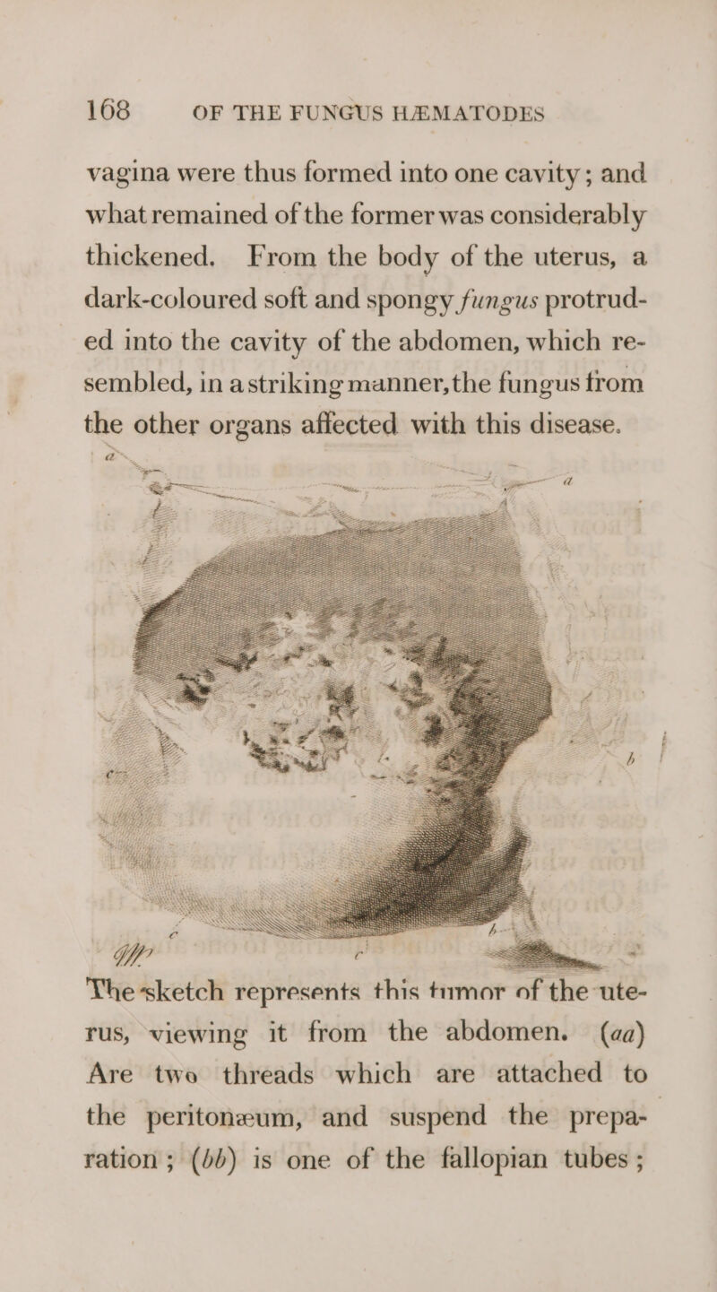 vagina were thus formed into one cavity; and what remained of the former was considerably thickened. From the body of the uterus, a dark-coloured soft and spongy fungus protrud- ed into the cavity of the abdomen, which re- sembled, in astriking manner,the fungus trom the other organs affected with this disease. a, E: qo a The sketch represents this tumor of the ute- rus, viewing it from the abdomen. (aa) Trio. the peritoneum, and suspend the prepa- ration ; (bb) is one of the fallopian tubes ;