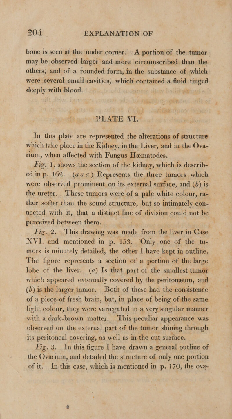 bone is seen at the under corner. A portion of the tumor may be observed larger and more circumscribed than the others, and of a rounded form, in the substance of which were several small cavities, which contained a fluid tinged deeply with blood. PLATE VI. In this plate are represented the alterations of structure which take place in the Kidney, in the Liver, and in the Ova- rium, when affected with Fungus Hematodes. vg. 1. shows the section of the kidney, which is describ- edim p. 162. (aaa) Represents the three tumors which were observed prominent on its external surface, and (0) is the ureter. ‘These tumors were of a pale white colour, ra- ther softer than the sound structure, but so intimately con- nected with it, that a distinct lme of division could not be perceived between them. 7 . Fig..2. This drawing was made from the liver in Case XVI. and mentioned in p. 153. Only one of the tu- mors is minutely detailed, the other I have kept in outline. The figure represents a section of a portion of the large lobe of the liver. (a) Is that part of the smallest tumor which appeared externally covered by the peritoneum, and (6) is the larger tumor. Both of these had the consistence of a piece of fresh brain, but, in place of being of the same light colour, they were variegated in a very singular manner with a dark-brown matter. ‘This peculiar appearance was observed on the external part of the tumor shining through its peritoneal covering, as well as in the cut surface. Fig. 3. In this figure I have drawn a general outline of the Ovarium, and detailed the structure of only one portion of it. In this case, which is mentioned in p. 170, the ova-