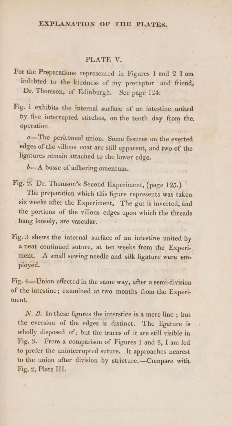 PLATE V. For the Preparations represented in Figures 1 and 2 Iam indebted to the kindness of my preceptor and friend, Dr. Thomson, of Edinburgh. See page 124. Fig. 1 exhibits the internal surface of an intestine. united by five interrupted stitches, on the tenth day from the, operation. a—The peritoneal union. Some fissures on the everted edges ofthe villous coat are still apparent, and two of the ligatures remain attached to the lower edge. 6—A bosse of adhering omentum. Fig. 2. Dr. Thomson’s Second Experiment, (page 125.) | The preparation which this figure represents was taken six weeks after the Experiment. The gut is inverted, and the portions of the villous edges upon which the ee hang loosely, are vascular. eat Fig. 3 shews the internal surface of an intestine dated by a neat continued suture, at ten weeks from the Experi- ment. A small sewing needle and silk ligature were em- ployed. © Fig. 4—-Union effected in the same way, after a semi-division of the intestine; examined at two months from the Experi- ment, N. B. In these figures the interstice is a mere line ; but the eversion of the edges is distinct. The ligature is wholly disposed of; but the traces of it are still visible in Fig. 3. From a comparison of Figures 1 and 3, I am led to prefer the uninterrupted suture. It approaches nearest to the union after division by stricture.—Compare with Fig. 2, Plate III. | a