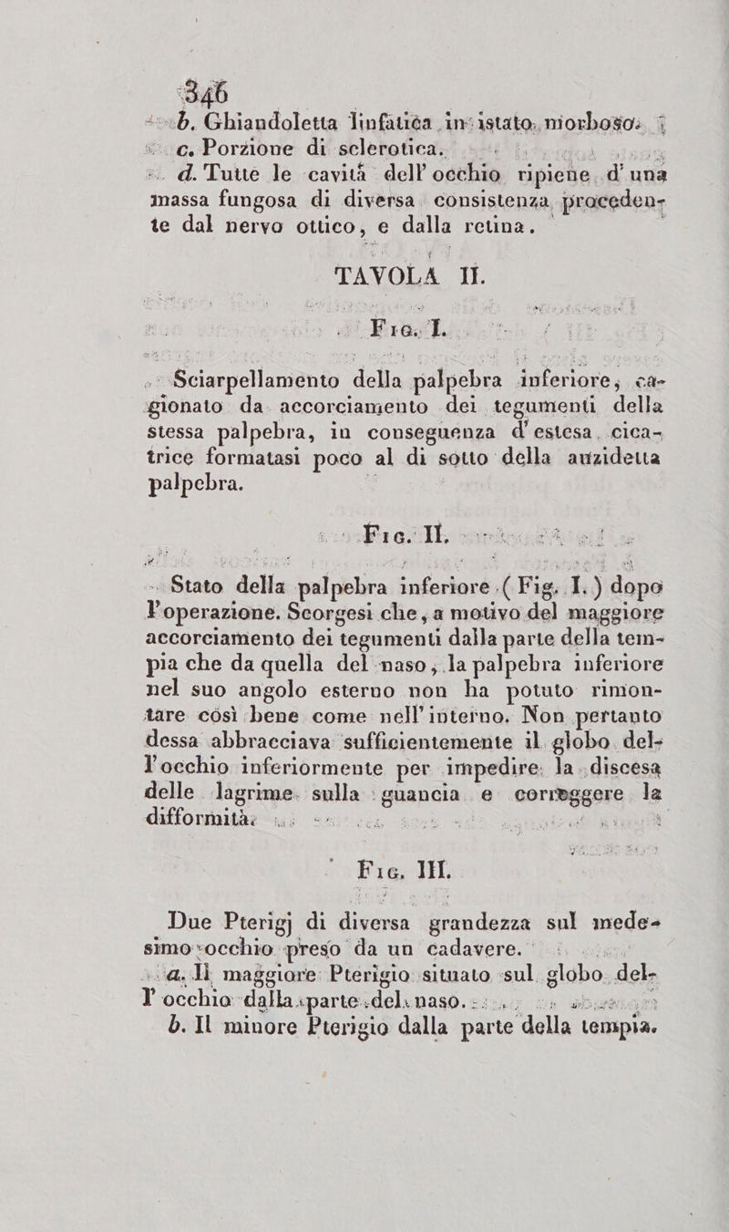 ‘346 “5, Ghiandoletta linfatiéa inistato; morboso: ; SqgePorzione: di-seletotica.i. si fiisiggà sison :.. d.Tuite le ‘cavità dell occhio ripiene. d’ una massa fungosa di diversa. consistenza praceden- te dal nervo ottico, e dalla retina. 4 TAVOLA Il. »:Sciarpellamento della palpebra inferiore, ca- gionato da. accorciamento dei tegumenti della stessa palpebra, in conseguenza d' estesa, cica- trice formatasi poco al di sotto della amzidetta palpebra. ja ) Sl Fi G. Il, area A l'operazione. Scorgesi che, a motivo del maggiore accorciamento dei tegumenti dalla parte della tem- pia che da quella del naso; .la palpebra inferiore nel suo angolo esterno non ha potuto rimon- tare còsì bene come nell'interno. Non pertanto dessa abbracciava sufficientemente il. globo. del- l'occhio inferiormente per impedire: la discesa delle lagrime. sulla : guancia e correggere la difformità: sr è ada CRITERI. F 16, IH. Due Pterigj di diversa grandezza sul mede- simo occhio preso da un cadavere. 3 :..@Il maggiore Pterigio situato :sul. globo. del- T' occhio dalla iparte.delinaso. ci. i sb ue b. Il minore Pterigio dalla parte della tenspia.