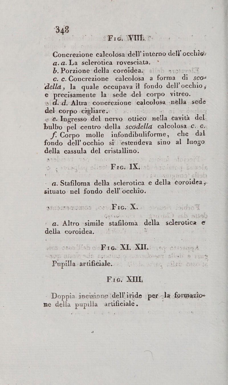 p ftt: “Fid. VII». Concrezione calcolosa-dell’interno dell''occhie: a.a.La sclerotica rovesciata. * b. Porzione: della coroidéa; «&gt; «io: c. c. Concrezione calcolosa a torna: Di sco= della, la quale occupava il fondo dell'occhio ; e precisamente la. sede del corpo vitreo. »'id.:d.: Altra» conerezione lealoolesa; mella. sede dal corpo :cigliare.: | «« ‘e. Ingresso. del nervo ottico” SR cavità SU bulbo pel centro «della scodella calcolosa.c.. c.. f. Corpo molle infondibuliforme, che dal fondo dell'occhio si’ ‘estendeva sino al luogo della cassula del cristallino. i Paella ASURIOn aa icin Mt g della core situato nel fondo dell'occhio. atrssssagansa sce Fio Ale aigni bidio i a. Altro crimilo stafiloma della Ctoodce ® della coroidea. hi 4 si IG. N ZII: 1 cu: SIENA 4 dry) i i Vasto)? Rig artificiale. REA O e sti 5 Fio. XIII - Doppia incisione ‘dell’iride ‘per. a formazio» ne della DIR a artificiale . af