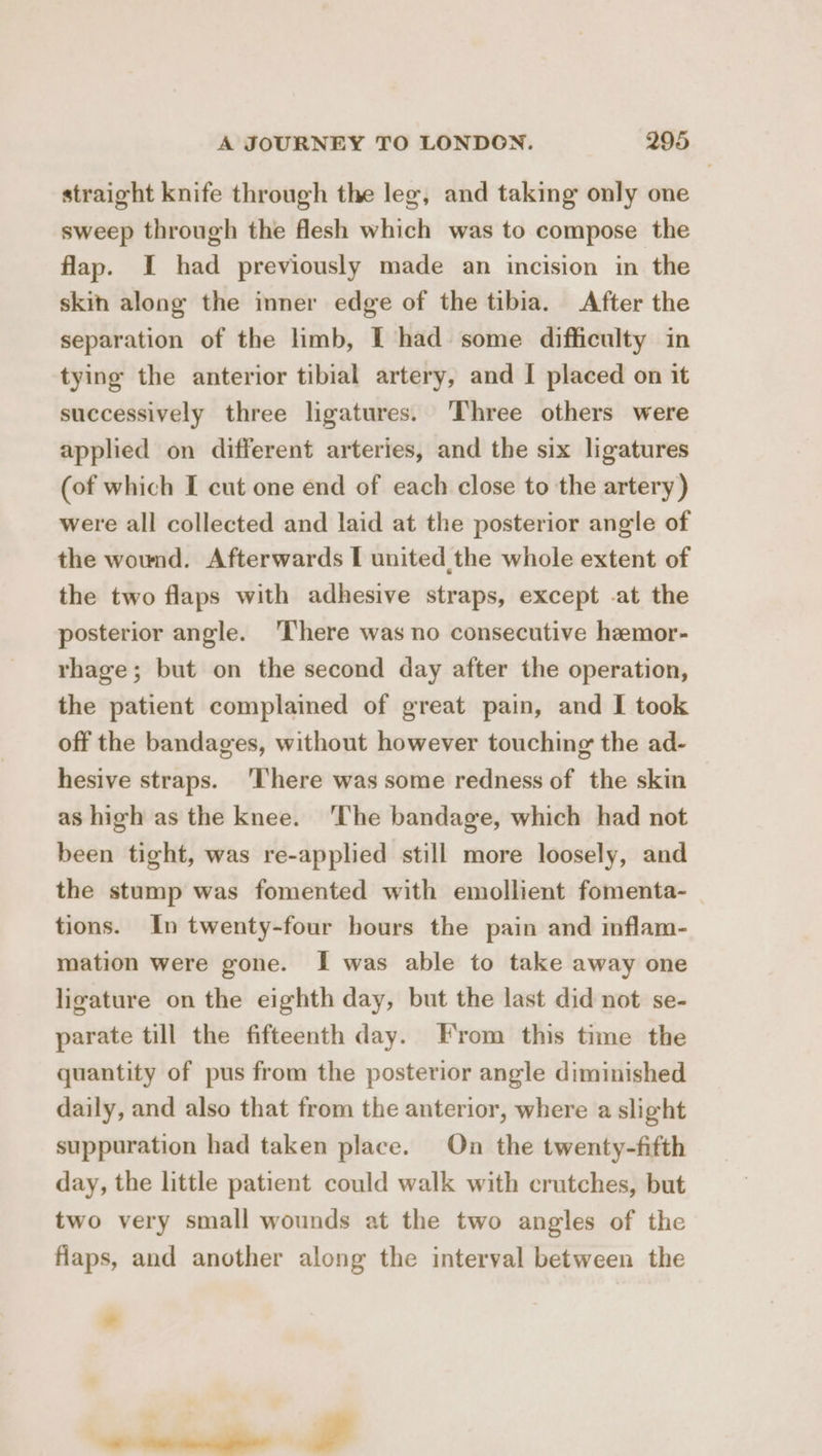 straight knife through the leg, and taking only one sweep through the flesh which was to compose the flap. I had previously made an incision in the skin along the inner edge of the tibia. After the separation of the limb, I had some difficulty in tying the anterior tibial artery, and I placed on it successively three ligatures. ‘Three others were applied on different arteries, and the six ligatures (of which I cut one end of each close to the artery) were all collected and laid at the posterior angle of the wound. Afterwards I united the whole extent of the two flaps with adhesive straps, except .at the posterior angle. ‘There was no consecutive hemor- rhage; but on the second day after the operation, the patient complained of great pain, and I took off the bandages, without however touching the ad- hesive straps. ‘There was some redness of the skin as high as the knee. ‘The bandage, which had not been tight, was re-applied still more loosely, and the stump was fomented with emollient fomenta- tions. In twenty-four hours the pain and inflam- mation were gone. I was able to take away one ligature on the eighth day, but the last did not se- parate till the fifteenth day. From this time the quantity of pus from the posterior angle diminished daily, and also that from the anterior, where a slight suppuration had taken place. On the twenty-fifth day, the little patient could walk with crutches, but two very small wounds at the two angles of the flaps, and another along the interval between the #
