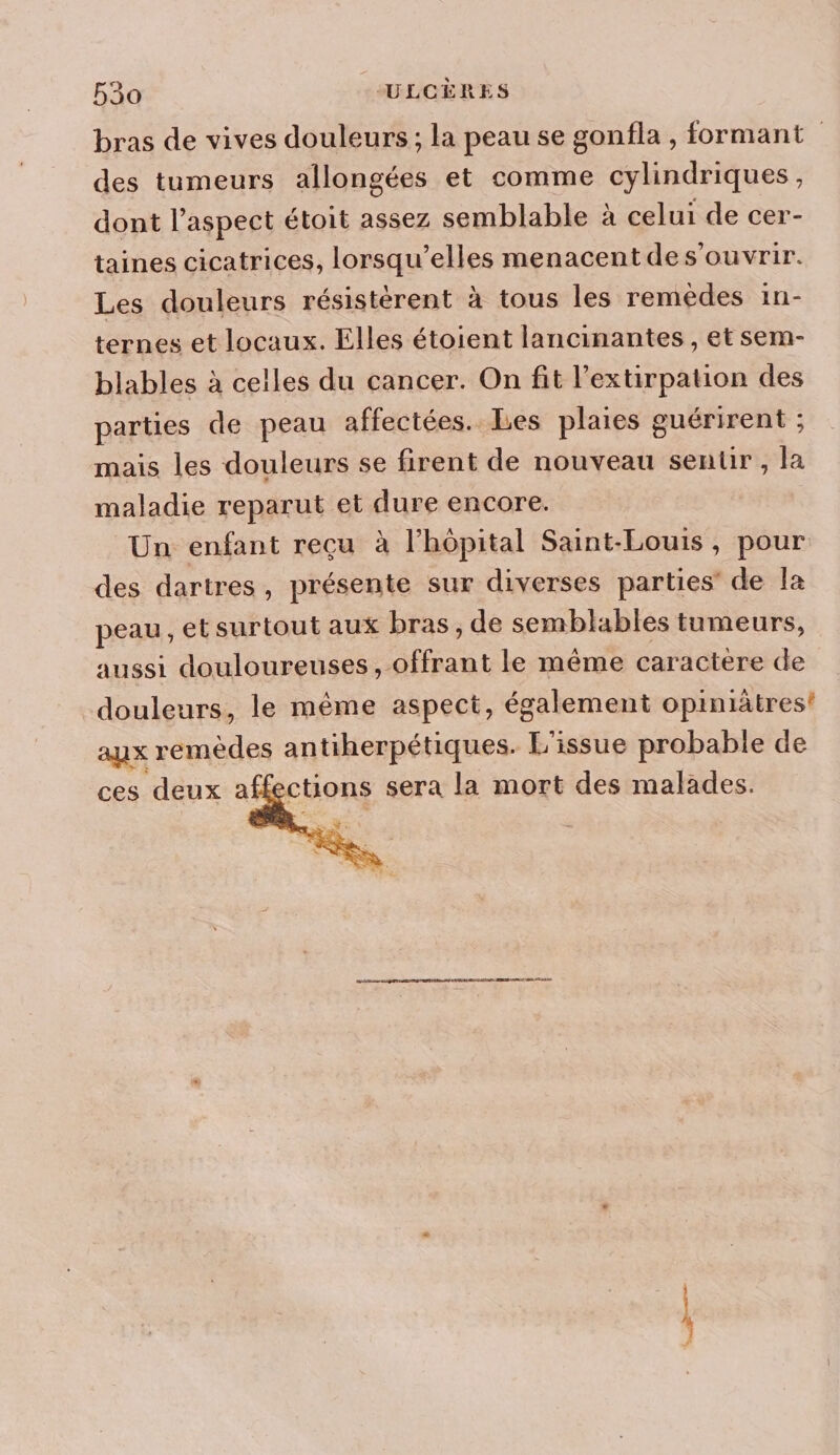 bras de vives douleurs ; la peau se gonfla , formant des tumeurs allongées et comme cylindriques, dont l'aspect étoit assez semblable à celui de cer- taines cicatrices, lorsqu'elles menacent des'ouvrir. Les douleurs résistérent à tous les remedes in- ternes et locaux. Elles étoient lancinantes, et sem- blables à celles du cancer. On fit l’extirpation des parties de peau affectées. Les plaies guérirent ; mais les douleurs se firent de nouveau sentir , la maladie reparut et dure encore. Un enfant reçu à l'hôpital Saint-Louis, pour des dartres, présente sur diverses parties de la peau, etsurtout aux bras, de semblables tumeurs, aussi douloureuses , offrant le même caractère de douleurs, le même aspect, également opiniâtres! aux remèdes antiherpétiques. L'issue probable de &gt;ctions sera la mort des malades. pe 6e en GE REED PRE TRAD AIDER