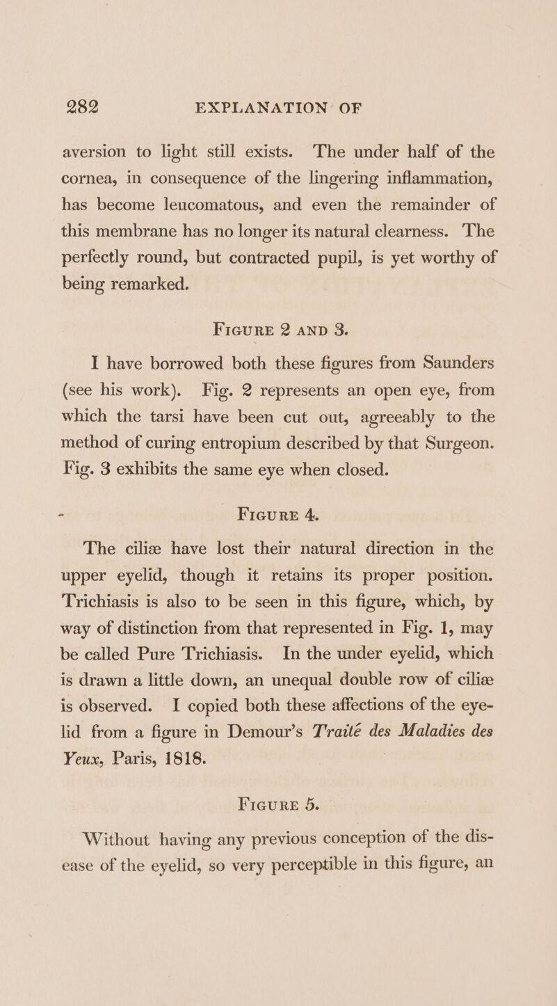 aversion to light still exists. The under half of the cornea, in consequence of the lingering inflammation, has become leucomatous, and even the remainder of this membrane has no longer its natural clearness. The perfectly round, but contracted pupil, is yet worthy of being remarked. FicuRE 2 AND 3. I have borrowed both these figures from Saunders (see his work). Fig. 2 represents an open eye, from which the tarsi have been cut out, agreeably to the method of curing entropium described by that Surgeon. Fig. 3 exhibits the same eye when closed. - FIGureE 4. The ciliz have lost their natural direction in the upper eyelid, though it retains its proper position. Trichiasis is also to be seen in this figure, which, by way of distinction from that represented in Fig. 1, may be called Pure Trichiasis. In the under eyelid, which is drawn a litthe down, an unequal double row of ciliz is observed. I copied both these affections of the eye- lid from a figure in Demour’s T'raité des Maladies des Yeux, Paris, 1818. | Figure 5. Without having any previous conception of the dis- ease of the eyelid, so very perceptible in this figure, an