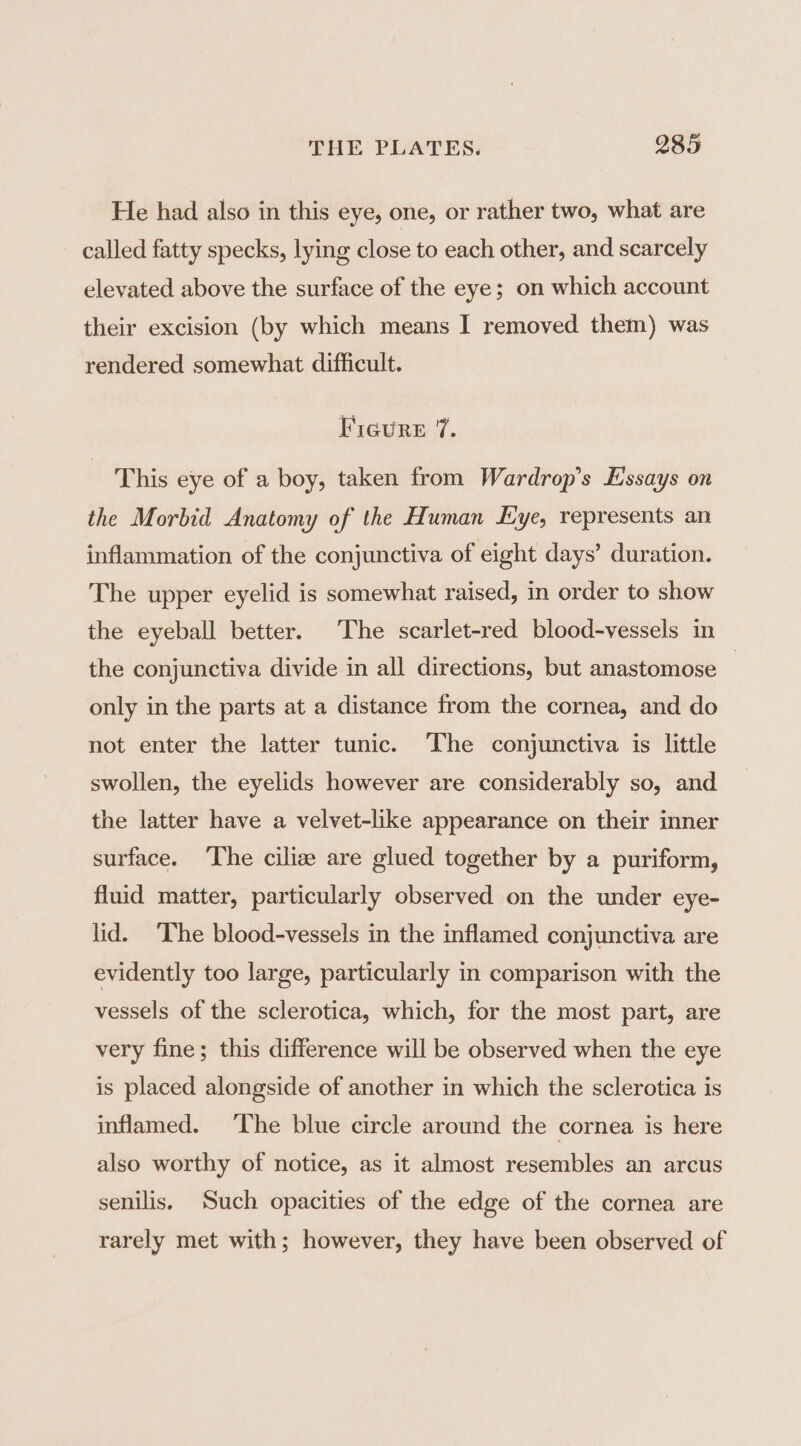 He had also in this eye, one, or rather two, what are called fatty specks, lying close to each other, and scarcely elevated above the surface of the eye; on which account their excision (by which means I removed them) was rendered somewhat difficult. Ficure 7. This eye of a boy, taken from Wardrop’s Essays on the Morbid Anatomy of the Human Eye, represents an inflammation of the conjunctiva of eight days’ duration. The upper eyelid is somewhat raised, in order to show the eyeball better. The scarlet-red blood-vessels in the conjunctiva divide in all directions, but anastomose | only in the parts at a distance from the cornea, and do not enter the latter tunic. The conjunctiva is little swollen, the eyelids however are considerably so, and the latter have a velvet-like appearance on their inner surface. ‘The ciliz are glued together by a puriform, fluid matter, particularly observed on the under eye- lid. ‘The blood-vessels in the inflamed conjunctiva are evidently too large, particularly in comparison with the vessels of the sclerotica, which, for the most part, are very fine; this difference will be observed when the eye is placed alongside of another in which the sclerotica is inflamed. ‘The blue circle around the cornea is here also worthy of notice, as it almost resembles an arcus senilis. Such opacities of the edge of the cornea are rarely met with; however, they have been observed of