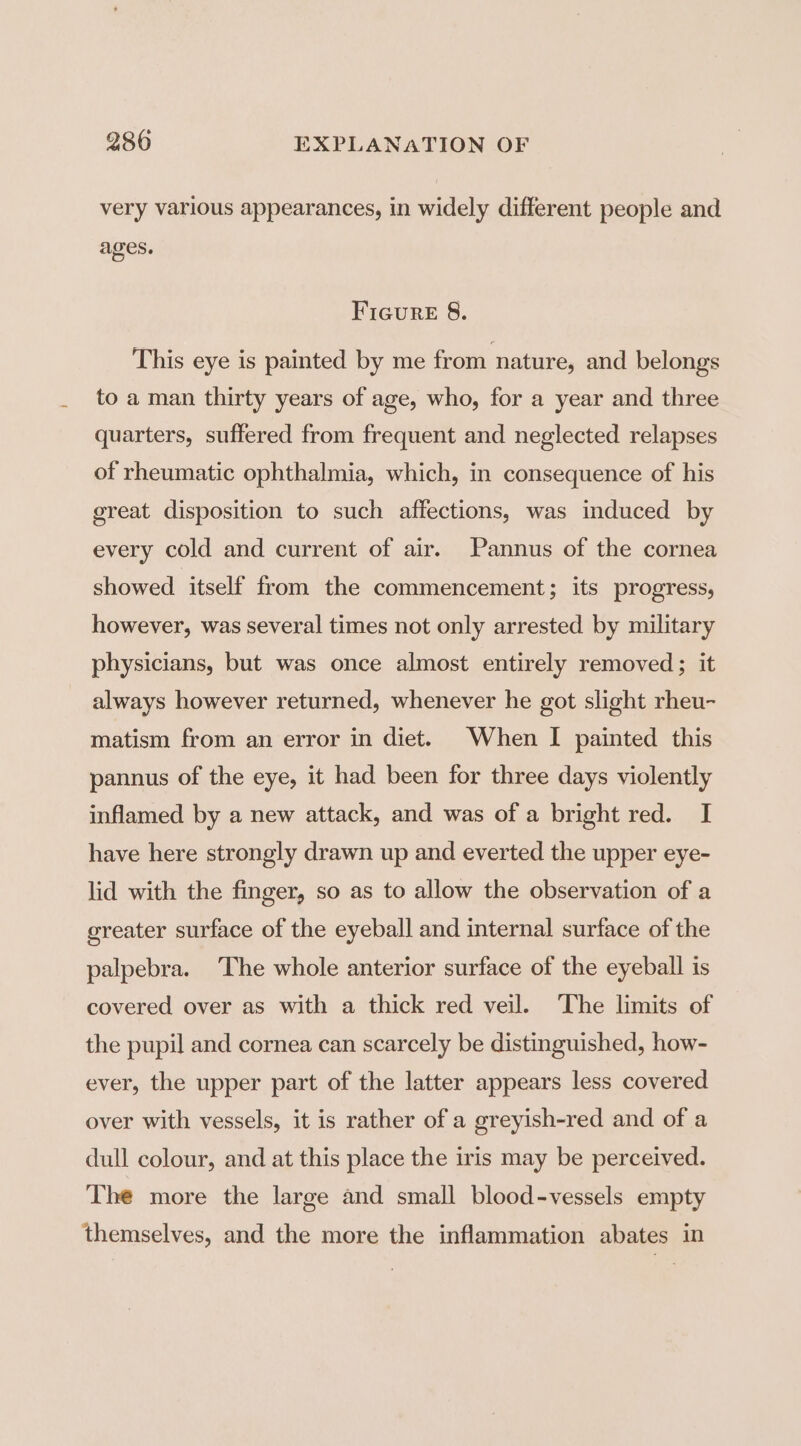 very various appearances, in widely different people and ages. Ficure 8. This eye is painted by me from nature, and belongs to a man thirty years of age, who, for a year and three quarters, suffered from frequent and neglected relapses of rheumatic ophthalmia, which, in consequence of his great disposition to such affections, was induced by every cold and current of air. Pannus of the cornea showed itself from the commencement; its progress, however, was several times not only arrested by military physicians, but was once almost entirely removed; it always however returned, whenever he got slight rheu- matism from an error in diet. When I painted this pannus of the eye, it had been for three days violently inflamed by a new attack, and was of a bright red. I have here strongly drawn up and everted the upper eye- lid with the finger, so as to allow the observation of a greater surface of the eyeball and internal surface of the palpebra. ‘The whole anterior surface of the eyeball is covered over as with a thick red veil. The limits of the pupil and cornea can scarcely be distinguished, how- ever, the upper part of the latter appears less covered over with vessels, it is rather of a greyish-red and of a dull colour, and at this place the iris may be perceived. The more the large and small blood-vessels empty themselves, and the more the inflammation abates in