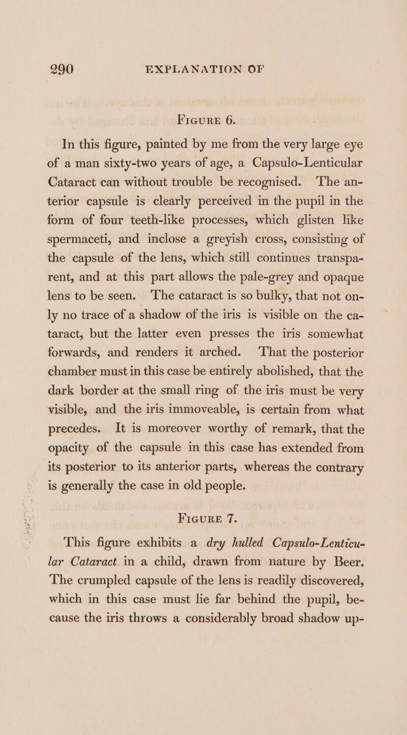 FIGuRE 6. In this figure, painted by me from the very large eye of a man sixty-two years of age, a Capsulo-Lenticular Cataract can without trouble be recognised. ‘The an- terior capsule is clearly perceived in the pupil in the form of four teeth-like processes, which glisten like spermaceti, and inclose a greyish cross, consisting of the capsule of the lens, which still continues transpa- rent, and at this part allows the pale-grey and opaque lens to be seen. ‘The cataract is so bulky, that not on- ly no trace of a shadow of the iris is visible on the ca- taract, but the latter even presses the iris somewhat forwards, and renders it arched. ‘That the posterior chamber must in this case be entirely abolished, that the dark border at the small ring of the iris must be very visible, and the iris immoveable, is certain from what precedes. It is moreover worthy of remark, that the opacity of the capsule in this case has extended from its posterior to its anterior parts, whereas the contrary is generally the case in old people. FIGURE 7. This figure exhibits a dry hulled Capsulo-Lenticu- lar Cataract. in a child, drawn from nature by Beer. The crumpled capsule of the lens is readily discovered, which in this case must lie far behind the pupil, be- cause the iris throws a considerably broad shadow up-