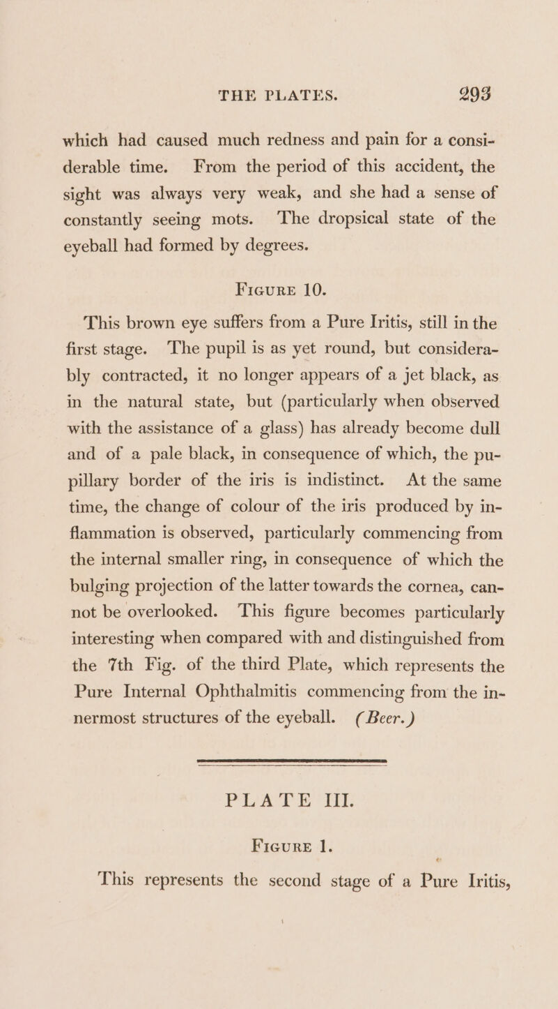 which had caused much redness and pain for a consi- derable time. From the period of this accident, the sight was always very weak, and she had a sense of constantly seeing mots. The dropsical state of the eyeball had formed by degrees. Figure 10. This brown eye suffers from a Pure Iritis, still in the first stage. The pupil is as yet round, but considera- bly contracted, it no longer appears of a jet black, as in the natural state, but (particularly when observed with the assistance of a glass) has already become dull and of a pale black, in consequence of which, the pu- pillary border of the iris is indistinct. At the same time, the change of colour of the iris produced by in- flammation is observed, particularly commencing from the internal smaller ring, in consequence of which the bulging projection of the latter towards the cornea, can- not be overlooked. This figure becomes particularly interesting when compared with and distinguished from the 7th Fig. of the third Plate, which represents the Pure Internal Ophthalmitis commencing from the in- nermost structures of the eyeball. (Beer. ) PUA BET Figure 1. This represents the second stage of a Pure Iritis,