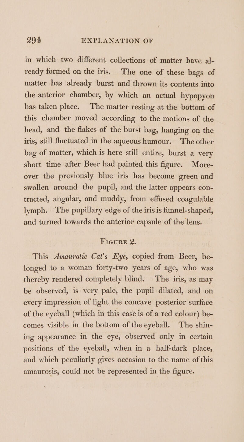 in which two different collections of matter have al- ready formed on the iris. The one of these bags of matter has already burst and thrown its contents into the anterior chamber, by which an actual hypopyon has taken place. The matter resting at the bottom of this chamber moved according to the motions of the head, and the flakes of the burst bag, hanging on the iris, still fluctuated in the aqueous humour. The other bag of matter, which is here still entire, burst a very short time after Beer had painted this figure. More- over the previously blue iris has become green and swollen around the pupil, and the latter appears con- tracted, angular, and muddy, from effused coagulable lymph. ‘The pupillary edge of the iris is funnel-shaped, and turned towards the anterior capsule of the lens. Figure 2. This Amaurotic Cat’s Eye, copied from Beer, be- longed to a woman forty-two years of age, who was thereby rendered completely blind. The iris, as may be observed, is very pale, the pupil dilated, and on every impression of light the concave posterior surface of the eyeball (which in this case is of a red colour) be- comes visible in the bottom of the eyeball. The shin- ing appearance in the eye, observed only in certain positions of the eyeball, when in a half-dark place, and which peculiarly gives occasion to the name of this amaurosis, could not be represented in the figure.