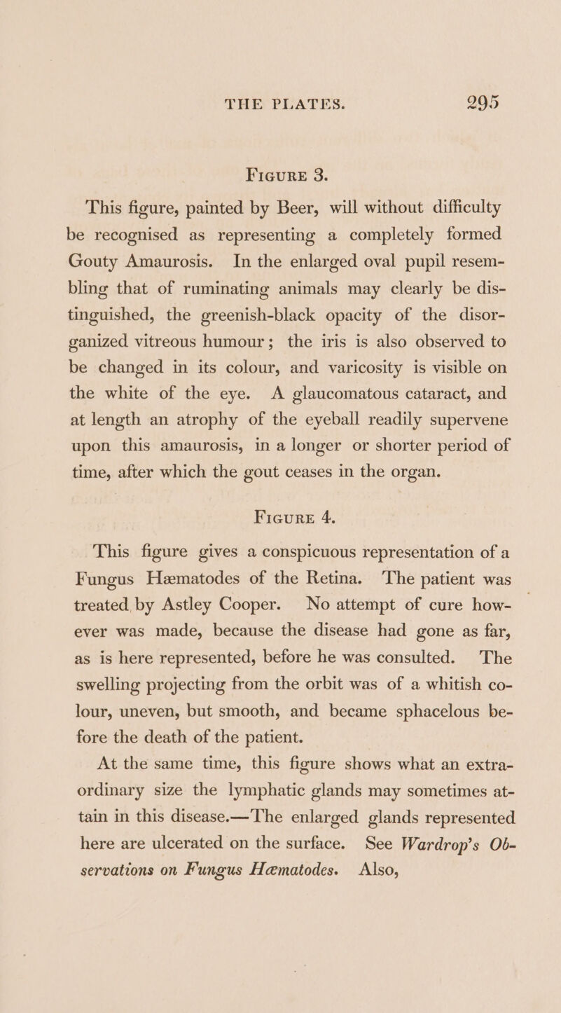 FiGure 3. This figure, painted by Beer, will without difficulty be recognised as representing a completely formed Gouty Amaurosis. In the enlarged oval pupil resem- bling that of ruminating animals may clearly be dis- tinguished, the greenish-black opacity of the disor- ganized vitreous humour; the iris is also observed to be changed in its colour, and varicosity is visible on the white of the eye. A glaucomatous cataract, and at length an atrophy of the eyeball readily supervene upon this amaurosis, in a longer or shorter period of time, after which the gout ceases in the organ. Figure 4. This figure gives a conspicuous representation of a Fungus Hematodes of the Retina. The patient was treated by Astley Cooper. No attempt of cure how- ever was made, because the disease had gone as far, as is here represented, before he was consulted. The swelling projecting from the orbit was of a whitish co- lour, uneven, but smooth, and became sphacelous be- fore the death of the patient. At the same time, this figure shows what an extra- ordinary size the lymphatic glands may sometimes at- tain in this disease.—The enlarged glands represented here are ulcerated on the surface. See Wardrop’s Ob- servations on Fungus Hematodes. Also,