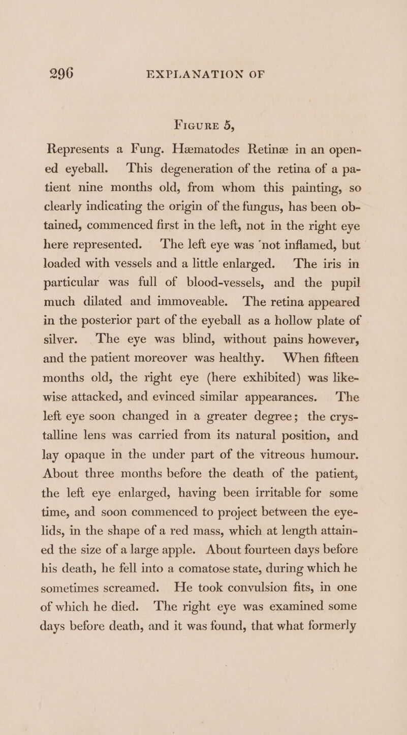 Fieure 5, Represents a Fung. Heematodes Retinge in an open- ed eyeball. This degeneration of the retina of a pa- tient nine months old, from whom this painting, so clearly indicating the origin of the fungus, has been ob- tained, commenced first in the left, not in the right eye here represented. ‘The left eye was ‘not inflamed, but loaded with vessels and a little enlarged. The iris in particular was full of blood-vessels, and the pupil much dilated and immoveable. The retina appeared in the posterior part of the eyeball as a hollow plate of silver. The eye was blind, without pains however, and the patient moreover was healthy. When fifteen months old, the right eye (here exhibited) was like- wise attacked, and evinced similar appearances. The left eye soon changed in a greater degree; the crys- talline lens was carried from its natural position, and lay opaque in the under part of the vitreous humour. About three months before the death of the patient, the left eye enlarged, having been irritable for some time, and soon commenced to project between the eye- lids, in the shape of a red mass, which at length attain- ed the size of a large apple. About fourteen days before his death, he fell into a comatose state, during which he sometimes screamed. He took convulsion fits, in one of which he died. The right eye was examined some days before death, and it was found, that what formerly