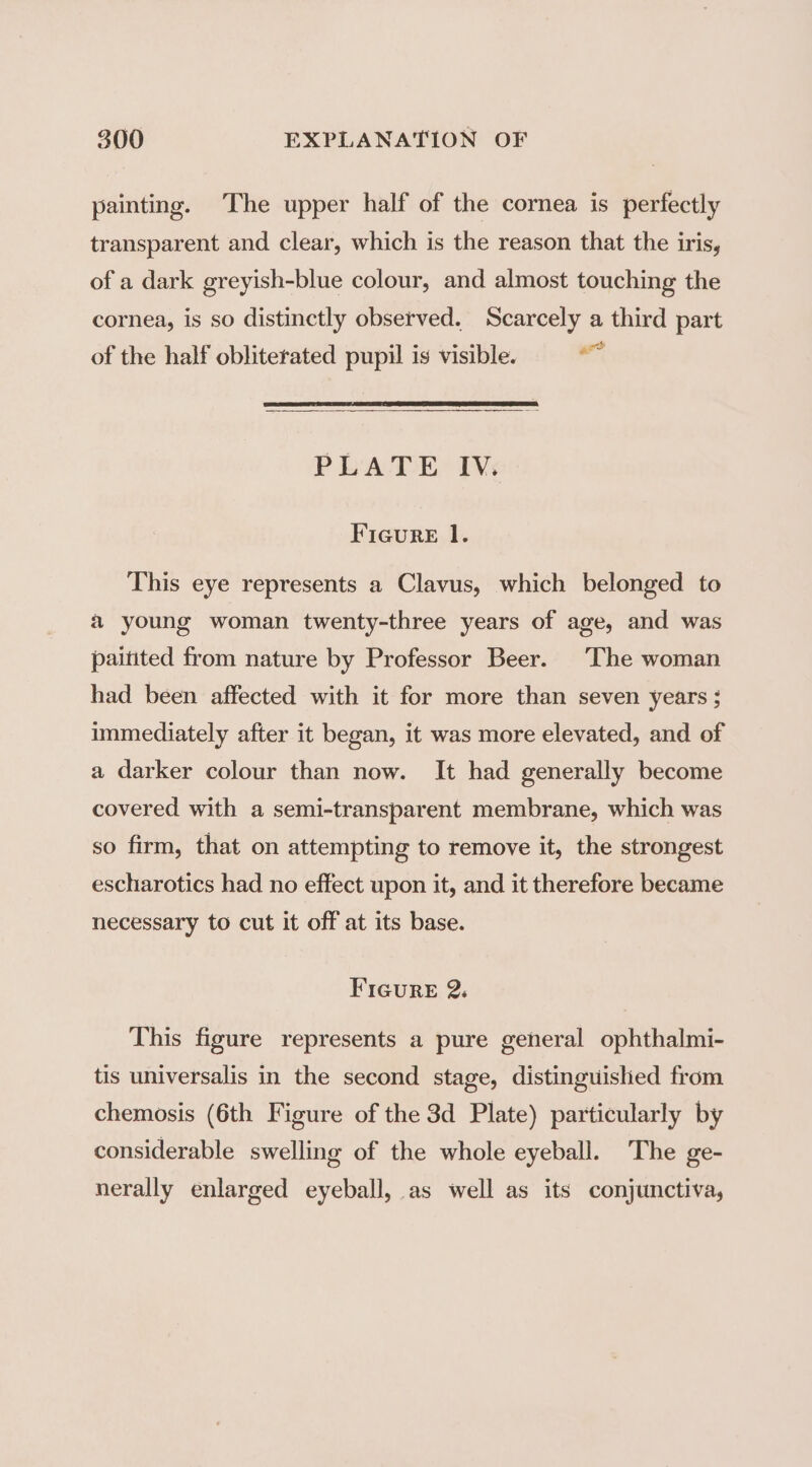 painting. The upper half of the cornea is perfectly transparent and clear, which is the reason that the iris, of a dark greyish-blue colour, and almost touching the cornea, is so distinctly observed. Scarcely a third part of the half obliterated pupil is visible. i PLATE IV. Figure l. This eye represents a Clavus, which belonged to a young woman twenty-three years of age, and was paitited from nature by Professor Beer. The woman had been affected with it for more than seven years ; immediately after it began, it was more elevated, and of a darker colour than now. It had generally become covered with a semi-transparent membrane, which was so firm, that on attempting to remove it, the strongest escharotics had no effect upon it, and it therefore became necessary to cut it off at its base. FiGureE 2. This figure represents a pure general ophthalmi- tis universalis in the second stage, distinguished from chemosis (6th Figure of the 3d Plate) particularly by considerable swelling of the whole eyeball. The ge- nerally enlarged eyeball, as well as its conjunctiva,