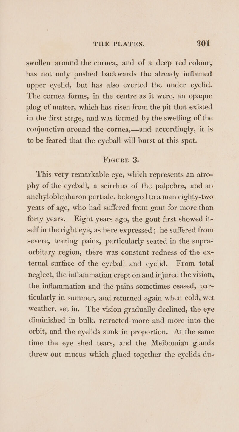 swollen around the cornea, and of a deep red colour, has not only pushed backwards the already inflamed upper eyelid, but has also everted the under eyelid. The cornea forms, in the centre as it were, an opaque plug of matter, which has risen from the pit that existed in the first stage, and was formed by the swelling of the conjunctiva around the cornea,—and accordingly, it is to be feared that the eyeball will burst at this spot. Figure 3. This very remarkable eye, which represents an atro- phy of the eyeball, a scirrhus of the palpebra, and an anchyloblepharon partiale, belonged to a man eighty-two years of age, who had suffered from gout for more than forty years. Eight years ago, the gout first showed it- self in the right eye, as here expressed; he suffered from severe, tearing pains, particularly seated in the supra- orbitary region, there was constant redness of the ex- ternal surface of the eyeball and eyelid. From total neglect, the inflammation crept on and injured the vision, the inflammation and the pains sometimes ceased, par- ticularly in summer, and returned again when cold, wet weather, set in. The vision gradually declined, the eye diminished in bulk, retracted more and more into the orbit, and the eyelids sunk in proportion. At the same time the eye shed tears, and the Meibomian glands threw out mucus which glued together the eyelids du-