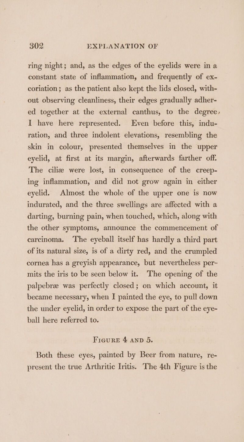 ring night; and, as the edges of the eyelids were in a constant state of inflammation, and frequently of ex- coriation; as the patient also kept the lids closed, with- out observing cleanliness, their edges gradually adher- ed together at the external canthus, to the degree, I have here represented. Even before this, indu- ration, and three indolent elevations, resembling the skin in colour, presented themselves in the upper eyelid, at first at its margin, afterwards farther off. The cilia were lost, in consequence of the creep- ing inflammation, and did not grow again in either eyelid. Almost the whole of the upper one is now indurated, and the three swellings are affected with a darting, burning pain, when touched, which, along with the other symptoms, announce the commencement of carcinoma. ‘The eyeball itself has hardly a third part of its natural size, is of a dirty red, and the crumpled cornea has a greyish appearance, but nevertheless per~ mits the iris to be seen below it. The opening of the palpebrze was perfectly closed; on which account, it became necessary, when I painted the eye, to pull down the under eyelid, in order to expose the part of the eye- ball here referred to. Figure 4 anp 5. Both these eyes, painted by Beer from nature, re- present the true Arthritic Iritis. The 4th Figure is the