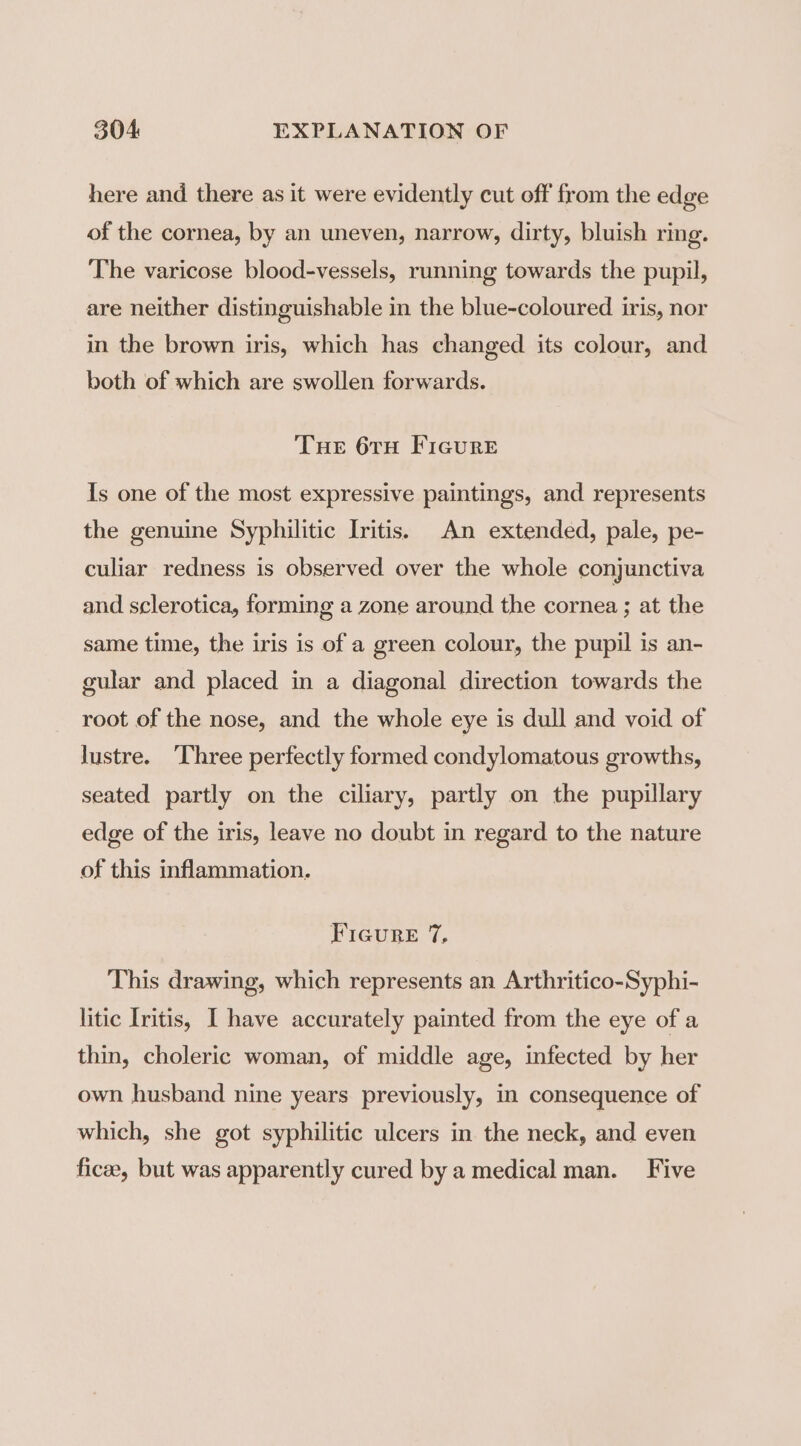 here and there as it were evidently cut off from the edge of the cornea, by an uneven, narrow, dirty, bluish ring. The varicose blood-vessels, running towards the pupil, are neither distinguishable in the blue-coloured iris, nor in the brown iris, which has changed its colour, and both of which are swollen forwards. Tue 6TH FIGURE Is one of the most expressive paintings, and represents the genuine Syphilitic Iritis. An extended, pale, pe- culiar redness is observed over the whole conjunctiva and sclerotica, forming a zone around the cornea; at the same time, the iris is of a green colour, the pupil is an- gular and placed in a diagonal direction towards the root of the nose, and the whole eye is dull and void of lustre. ‘Three perfectly formed condylomatous growths, seated partly on the ciliary, partly on the pupillary edge of the iris, leave no doubt in regard to the nature of this inflammation. PIGURE, T, This drawing, which represents an Arthritico-Syphi- litic Iritis, I have accurately painted from the eye of a thin, choleric woman, of middle age, infected by her own husband nine years previously, in consequence of which, she got syphilitic ulcers in the neck, and even ficee, but was apparently cured by a medical man. Five