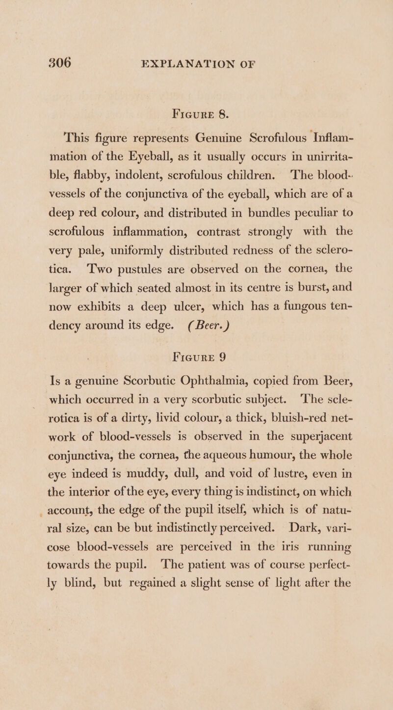 Ficure 8. This figure represents Genuine Scrofulous Inflam- mation of the Eyeball, as it usually occurs in unirrita- ble, flabby, indolent, scrofulous children. The blood-: vessels of the conjunctiva of the eyeball, which are of a deep red colour, and distributed in bundles peculiar to scrofulous inflammation, contrast strongly with the very pale, uniformly distributed redness of the sclero- tica. Two pustules are observed on the cornea, the larger of which seated almost in its centre is burst, and now exhibits a deep ulcer, which has a fungous ten- dency around its edge. (Beer.) Figure 9 Is a genuine Scorbutic Ophthalmia, copied from Beer, which occurred in a very scorbutic subject. ‘The scle- rotica is of a dirty, livid colour, a thick, bluish-red net- work of blood-vessels is observed in the superjacent conjunctiva, the cornea, the aqueous humour, the whole eye indeed is muddy, dull, and void of lustre, even in the interior of the eye, every thing is indistinct, on which _ account, the edge of the pupil itself, which is of natu- ral size, can be but indistinctly perceived. Dark, vari- cose blood-vessels are perceived in the iris running towards the pupil. The patient was of course perfect- ly blind, but regained a slight sense of light after the