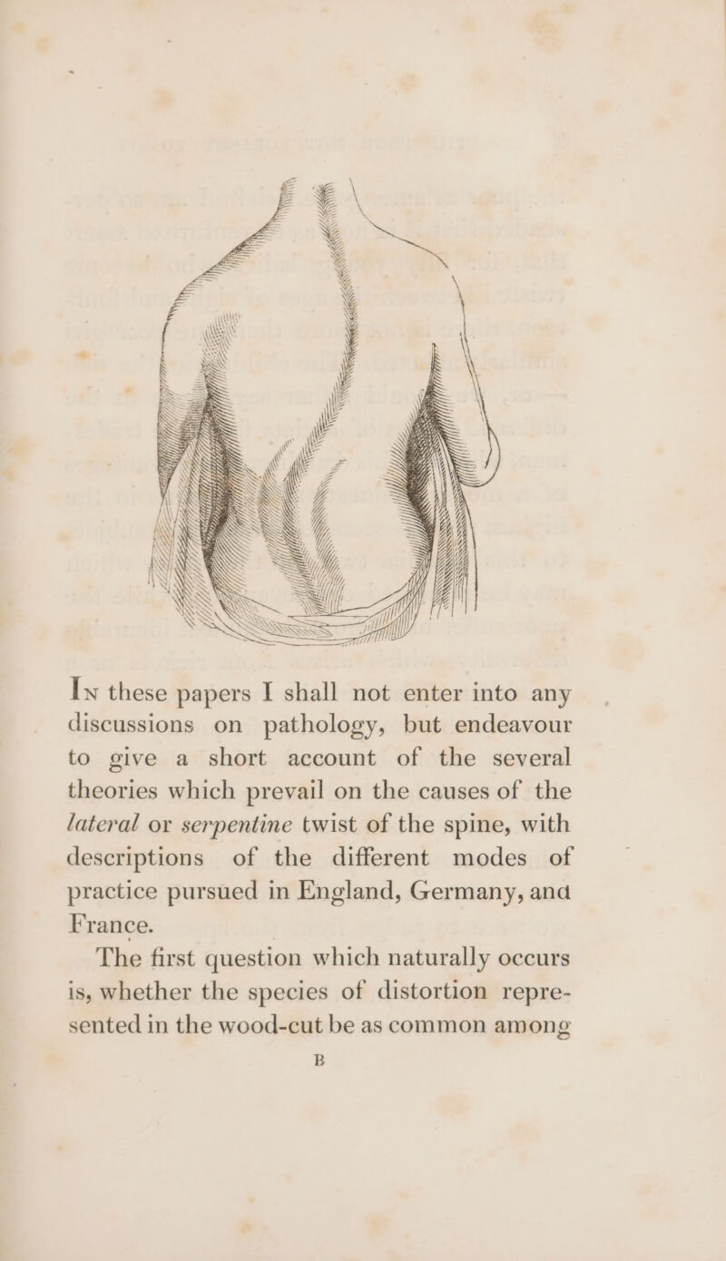 SSS SSSwr SASS SQA Wiss SWS k MK Ww Iw these papers I shall not enter into any discussions on pathology, but endeavour to give a short account of the several theories which prevail on the causes of the lateral or serpentine twist of the spine, with descriptions of the different modes of practice pursued in England, Germany, and France. | The first question which naturally occurs is, whether the species of distortion repre- sented in the wood-cut be as common among B