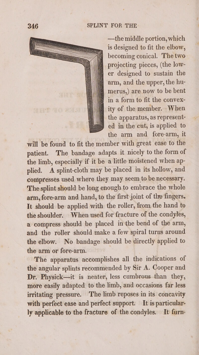 —the middle portion, which wy, iS designed to fit the elbow, lq becoming conical. The two A\\lia projecting pieces, (the low- ij er designed to sustain the i arm, and the upper, the hu- i merus,) are now to be bent f in a form to fit the convex- ity of the member. -When |W the apparatus, as represent- y ed in the cut, is applied to the arm and fore-arm, it will be found to fit the member with great ease to the patient. The bandage adapts it nicely to the form of the limb, especially if it be a little moistened when ap- plied. A splint-cloth may be placed in its hollow, and compresses used where they may seem to be necessary. ‘The splint should be long enough to embrace the whole arm, fore-arm and hand, to the first joint of the fingers. It should be applied with the roller, from the hand to the shoulder. When used for fracture of the condyles, a compress should be placed inthe bend of the arm, and the roller should make a few spiral turns around the elbow. No bandage should be directly applied to the arm or fore-arm. The apparatus accomplishes all the indications of the angular splints recommended by Sir A. Cooper and Dr. Physick—it is neater, less cumbrous than they, more easily adapted to the limb, and occasions far less irritating pressure. ‘The limb reposes in its concavity with perfect ease and perfect support. It is particular- ly applicable to the fracture of the condyles. It furn-