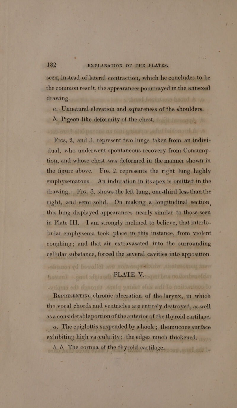 seen, instead of lateral contraction, which he concludes to be the common result, the appearances pourtrayed in the annexed drawing. a. Unnatural elevation and squareness of the shoulders. b. Pigeon-like deformity of the chest. Fics, 2. and 3. represent two lungs taken from an indivi- dual, who underwent spontaneous recovery from Consump- tion, and whose chest was deformed in the manner shown in the figure above. Fie. 2. represents the right lung highly emphysematous. An induration in its apex is omitted in the drawing. Fic. 3, shows the left lung, one-third less than the right, and semi-solid. On making a longitudinal section, this lung displayed appearances nearly similar to those seen in Plate IT. Iam strongly inclined to believe, that interlo- bular emphysema took place in this instance, from violent coughing; and that air extravasated into the surrounding cellular substance, forced the several cavities into apposition. vet rym wt PLALEnV.; Representine chronic ulceration of the larynx, in which the vocal chords and ventricles are entirely destroyed, as well as a considerable portion of the anterior of the thyroid cartilage. _ a. The epiglottis suspended by ahook ; themucous surface exhibiting high va:cularity ; the edges much thickened. 5. b, The cornua of the thyroid cartilaze.