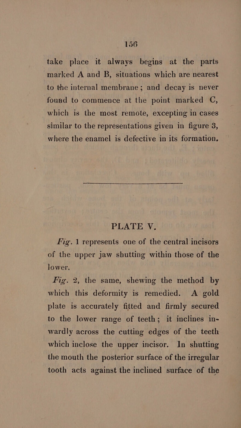 take place it always begins at the parts marked A and B, situations which are nearest to the internal membrane ; and decay is never found to commence at the point marked C, which is the most remote, excepting in cases similar to the representations given in figure 3, where the enamel is defective in its formation. PLATE V. fig. 1 represents one of the central incisors of the upper jaw shutting within those of the lower. Fig. 2, the same, shewing the method by which this deformity is remedied. A gold plate is accurately fitted and firmly secured to the lower range of teeth; it inclines in- wardly across the cutting edges of the teeth which inclose the upper incisor. In shutting the mouth the posterior surface of the irregular tooth acts against the inclined surface of the