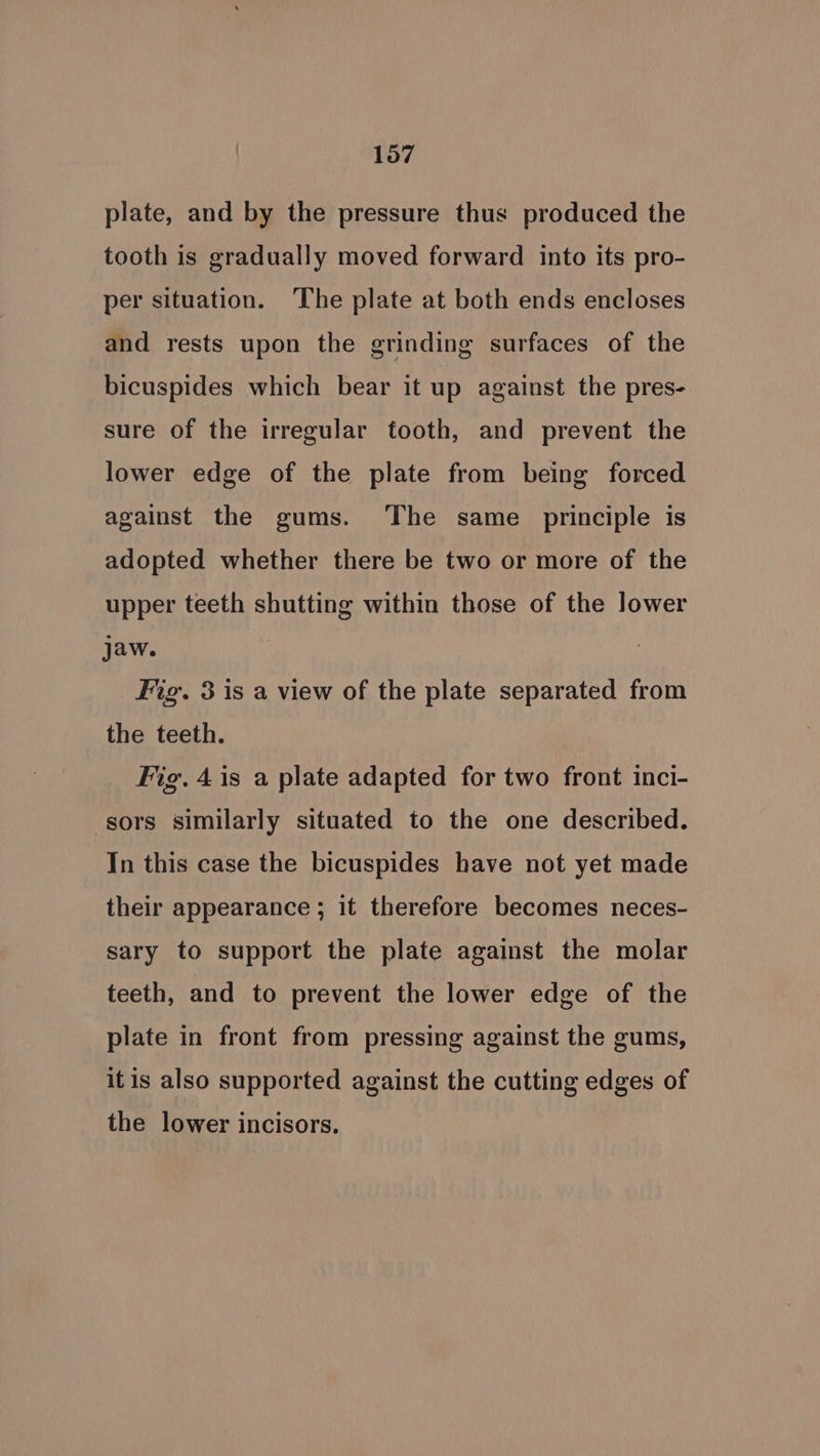 plate, and by the pressure thus produced the tooth is gradually moved forward into its pro- per situation. The plate at both ends encloses and rests upon the grinding surfaces of the bicuspides which bear it up against the pres- sure of the irregular tooth, and prevent the lower edge of the plate from being forced against the gums. The same principle is adopted whether there be two or more of the upper teeth shutting within those of the lower jaw. Fig. 3 is a view of the plate separated from the teeth. Fig. 4 is a plate adapted for two front inci- sors similarly situated to the one described. In this case the bicuspides have not yet made their appearance ; it therefore becomes neces- sary to support the plate against the molar teeth, and to prevent the lower edge of the plate in front from pressing against the gums, itis also supported against the cutting edges of the lower incisors.