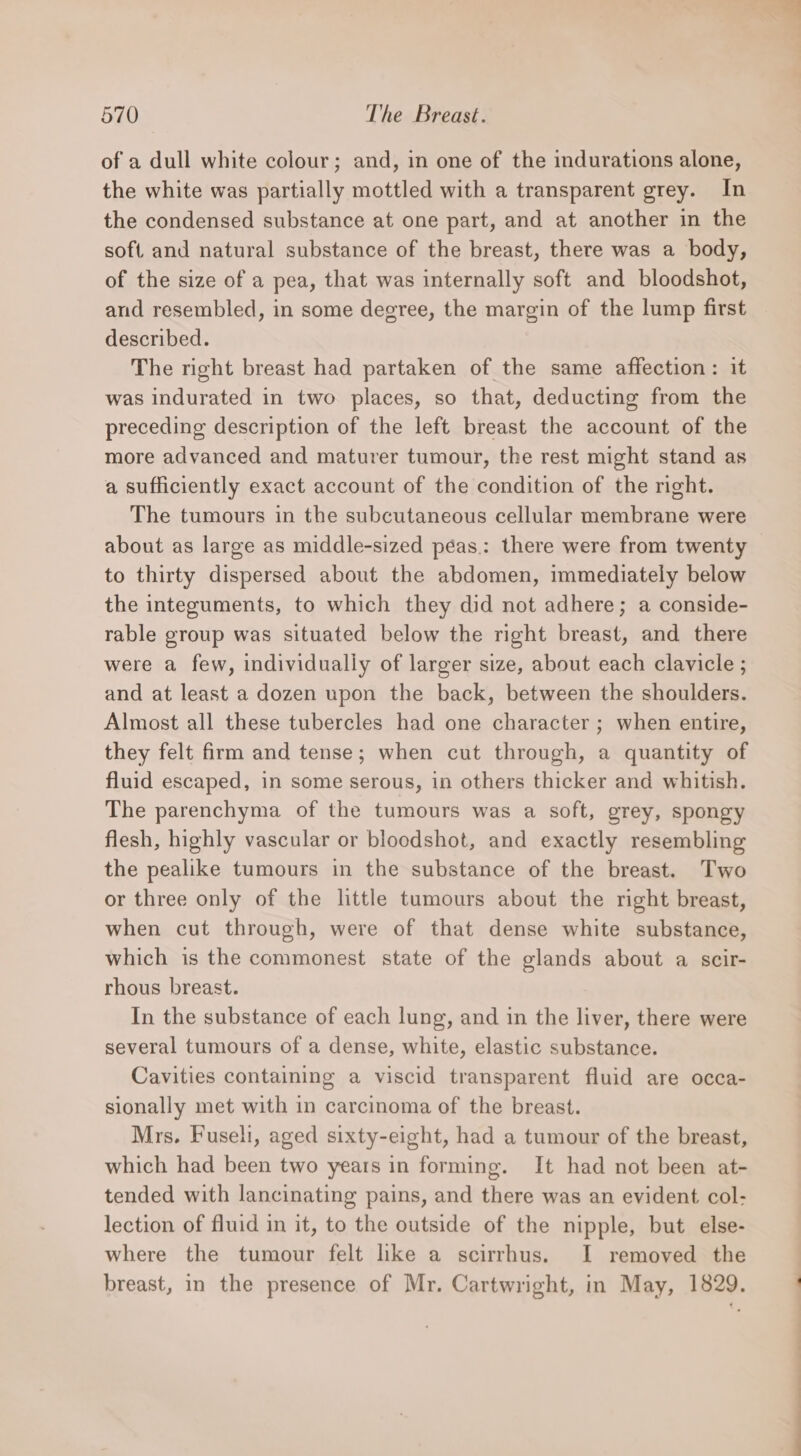 of a dull white colour; and, in one of the indurations alone, the white was partially mottled with a transparent grey. In the condensed substance at one part, and at another in the soft and natural substance of the breast, there was a body, of the size of a pea, that was internally soft and bloodshot, and resembled, in some degree, the margin of the lump first described. The right breast had partaken of the same affection: it was indurated in two places, so that, deducting from the preceding description of the left breast the account of the more advanced and maturer tumour, the rest might stand as a sufficiently exact account of the condition of the right. The tumours in the subcutaneous cellular membrane were to thirty dispersed about the abdomen, immediately below the integuments, to which they did not adhere; a conside- rable group was situated below the right breast, and there were a few, individually of larger size, about each clavicle ; and at least a dozen upon the back, between the shoulders. Almost all these tubercles had one character ; when entire, they felt firm and tense; when cut through, a quantity of fluid escaped, in some serous, in others thicker and whitish. The parenchyma of the tumours was a soft, grey, spongy flesh, highly vascular or bloodshot, and exactly resembling the pealike tumours in the substance of the breast. Two or three only of the little tumours about the right breast, when cut through, were of that dense white substance, which is the commonest state of the glands about a scir- rhous breast. In the substance of each lung, and in the liver, there were several tumours of a dense, white, elastic substance. Cavities containing a viscid transparent fluid are occa- sionally met with in carcinoma of the breast. Mrs. Fuseli, aged sixty-eight, had a tumour of the breast, which had been two years in forming. It had not been at- tended with lancinating pains, and there was an evident col- lection of fluid in it, to the outside of the nipple, but else- where the tumour felt like a scirrhus. I removed the breast, in the presence of Mr. Cartwright, in May, 1829. es