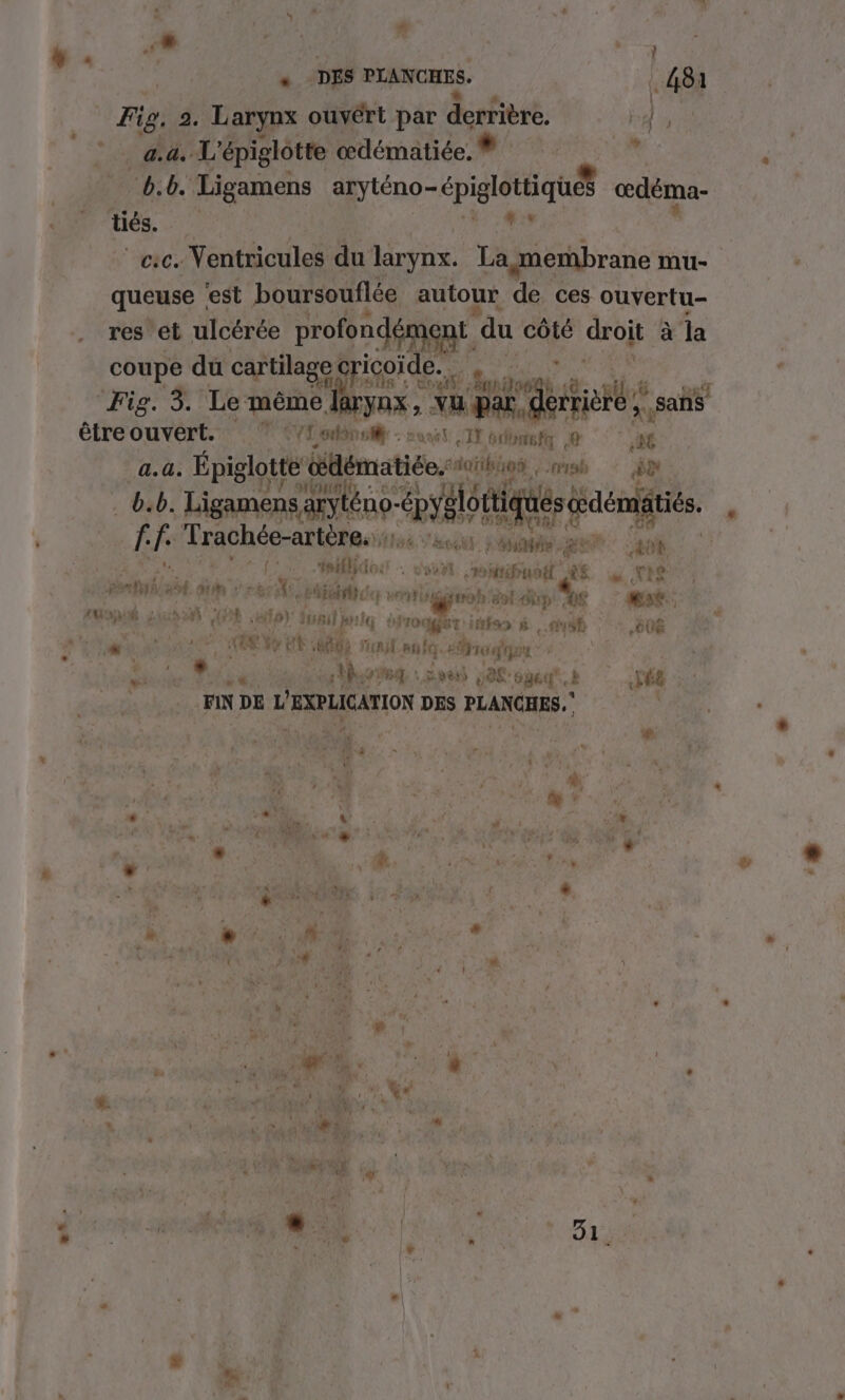 ve - # COR | # ; + . * ; | Fig. 2. Larynx ouvért par derfivié. | | ‘53% NT L'épiglotte dématiée ® EEE im “b. b. Ligamens aryténo-épiglottiques œdéma- tiés. AE Le vie: Yentricules du larynx. La membrane mu- queuse ‘est boursouflée autour de ces ouvertu- res et ulcérée profondément ‘du côté droit : à la coupe du cartilage ricoide. Fig. 3. Le même larynx “gt, sañS ve x étreouvert.” 7 (Lens - IE odbaufe © a. à. Épiglotte b'Éématide: doibioS : rh ra dpi APT bib. Ligamens ANA téno- “épy! lottiqu ML cdémätiés. , f: f. Trachée-artère. | : Are mé : “os. à sous, REP: 408 CAT Ados doutt roiétifuit 26 “NE : PATNTIE st di eur chine un un. ent 11p QE Æse: EopUÉ sub (PE ete): dau juriq droit itton CASE 606 ; S'ENCRT ET ee Ve et Qu Fonyl. Que crop «0 ASS IE th EL DETTE ET 7TT k PRE FIN DE L' AXRLICATION DES PLANCHES. UNE 2. # Ù t $ { À % 4 * k à 4 1 + % ù PE  «: ) st J œ * CRE). CR EE PRO « +: , ii PRE #. à A. sd k v é” ë “ ts 3 $ w “ : 1: de s: l PRE t { j A .: pe ? 4 | &amp; ‘ “A Ft »# 3 v 1 # L 7: C3 dr NY L! &amp; DT RL % x FPE ‘9 ! + L] Ci ri | « 4 51 ta Ks *| + | + g x