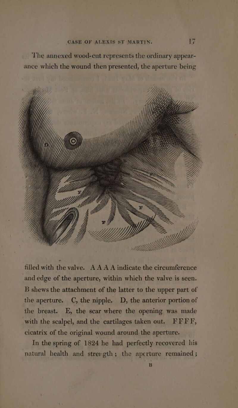 The annexed wood-cut represents the ordinary appear- PWS y) S : , Yi filled with the valve. A A A A indicate the circumference and edge of the aperture, within which the valve is seen. ly, B shews the attachment of the latter to the upper part of the aperture. (C, the nipple. D, the anterior portion of the breast. E, the scar where the opening was made with the scalpel, and the cartilages taken out. -FFFF, cicatrix of the original wound around the aperture. In the spring of 1824 he had perfectly recovered his natural health and strength; the aperture remained ; B