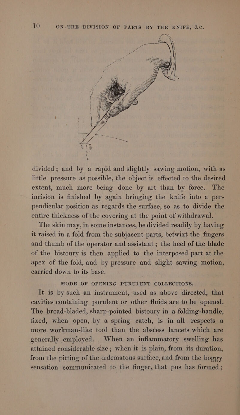 WY (al |) “WY mn | \\YAR divided ; and by a rapid and slightly sawing motion, with as little pressure as possible, the object is effected to the desired extent, much more being done by art than by force. The incision is finished by again bringing the knife into a per- pendicular position as regards the surface, so as to divide the entire thickness of the covering at the point of withdrawal. The skin may, in some instances, be divided readily by having it raised in a fold from the subjacent parts, betwixt the fingers and thumb of the operator and assistant ; the heel of the blade of the bistoury is then applied to the interposed part at the apex of the fold, and by pressure and slight sawing motion, carried down to its base. MODE OF OPENING PURULENT COLLECTIONS. It is by such an instrument, used as above directed, that cavities containing purulent or other fluids are to be opened. The broad-bladed, sharp-pointed bistoury in a folding-handle, fixed, when open, by a spring catch, is in all respects a more workman-like tool than the abscess lancets which are generally employed. . When an inflammatory swelling has attained considerable size; when it is plain, from its duration, from the pitting of the oedematous surface, and from the boggy sensation communicated to the finger, that pus has formed ;