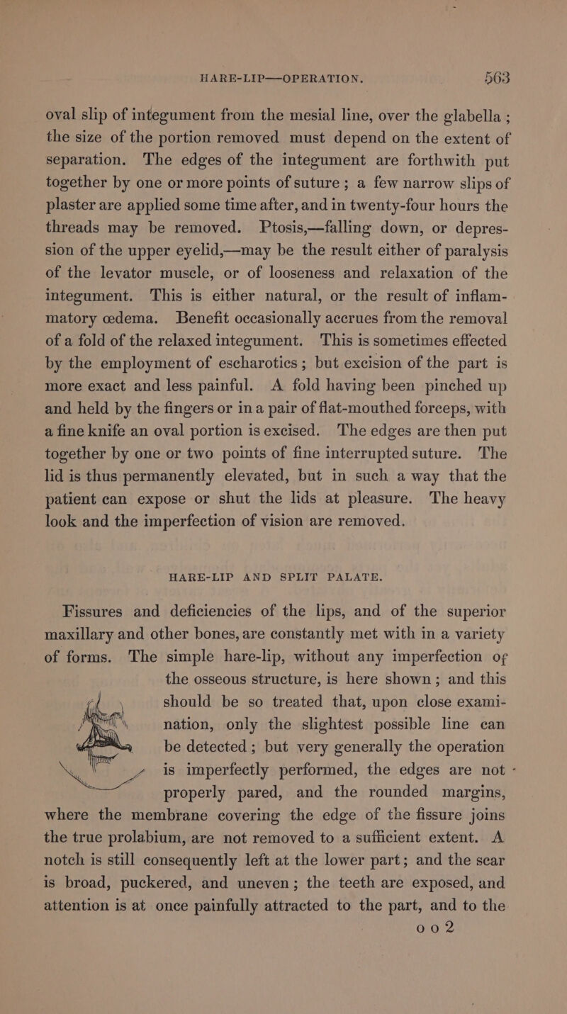 oval slip of integument from the mesial line, over the glabella ; the size of the portion removed must depend on the extent of separation. The edges of the integument are forthwith put together by one or more points of suture ; a few narrow slips of plaster are applied some time after, and in twenty-four hours the threads may be removed. Ptosis,—falling down, or depres- sion of the upper eyelid,—may be the result either of paralysis of the levator muscle, or of looseness and relaxation of the integument. This is either natural, or the result of inflam- matory oedema. Benefit occasionally accrues from the removal of a fold of the relaxed integument. This is sometimes effected by the employment of escharotics; but excision of the part is more exact and less painful. A fold having been pinched up and held by the fingers or ina pair of flat-mouthed forceps, with a fine knife an oval portion is excised. The edges are then put together by one or two points of fine interrupted suture. The lid is thus permanently elevated, but in such a way that the patient can expose or shut the lids at pleasure. The heavy look and the imperfection of vision are removed. HARE-LIP AND SPLIT PALATE. Fissures and deficiencies of the lips, and of the superior maxillary and other bones, are constantly met with in a variety of forms. The simple hare-lip, without any imperfection of the osseous structure, is here shown; and this should be so treated that, upon close exami- nation, only the slightest possible line can be detected ; but very generally the operation is imperfectly performed, the edges are not - properly pared, and the rounded margins, where the membrane covering the edge of the fissure joins the true prolabium, are not removed to a sufficient extent. A notch is still consequently left at the lower part; and the scar is broad, puckered, and uneven; the teeth are exposed, and attention is at once painfully attracted to the part, and to the 002