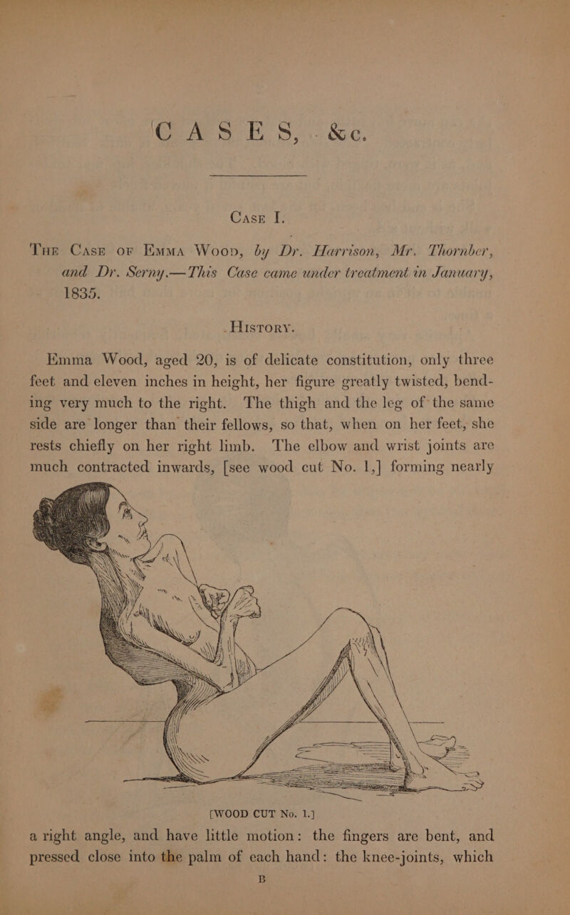 Case: FE: Tue Cast or Emma Woop, by Dr. Harrison, Mr. Thornber » UY 9 ’ and Dr. Serny.—This Case came under treatment in January, 1835. _History. Emma Wood, aged 20, is of delicate constitution, only three feet and eleven inches in height, her figure greatly twisted, bend- ing very much to the right. The thigh and the leg of the same side are longer than their fellows, so that, when on her feet, she rests chiefly on her right limb. The elbow and wrist joints are much contracted inwards, [see wood cut No. 1,] forming nearly aright angle, and have little motion: the fingers are bent, and pressed close into the palm of each hand: the knee-joints, which B